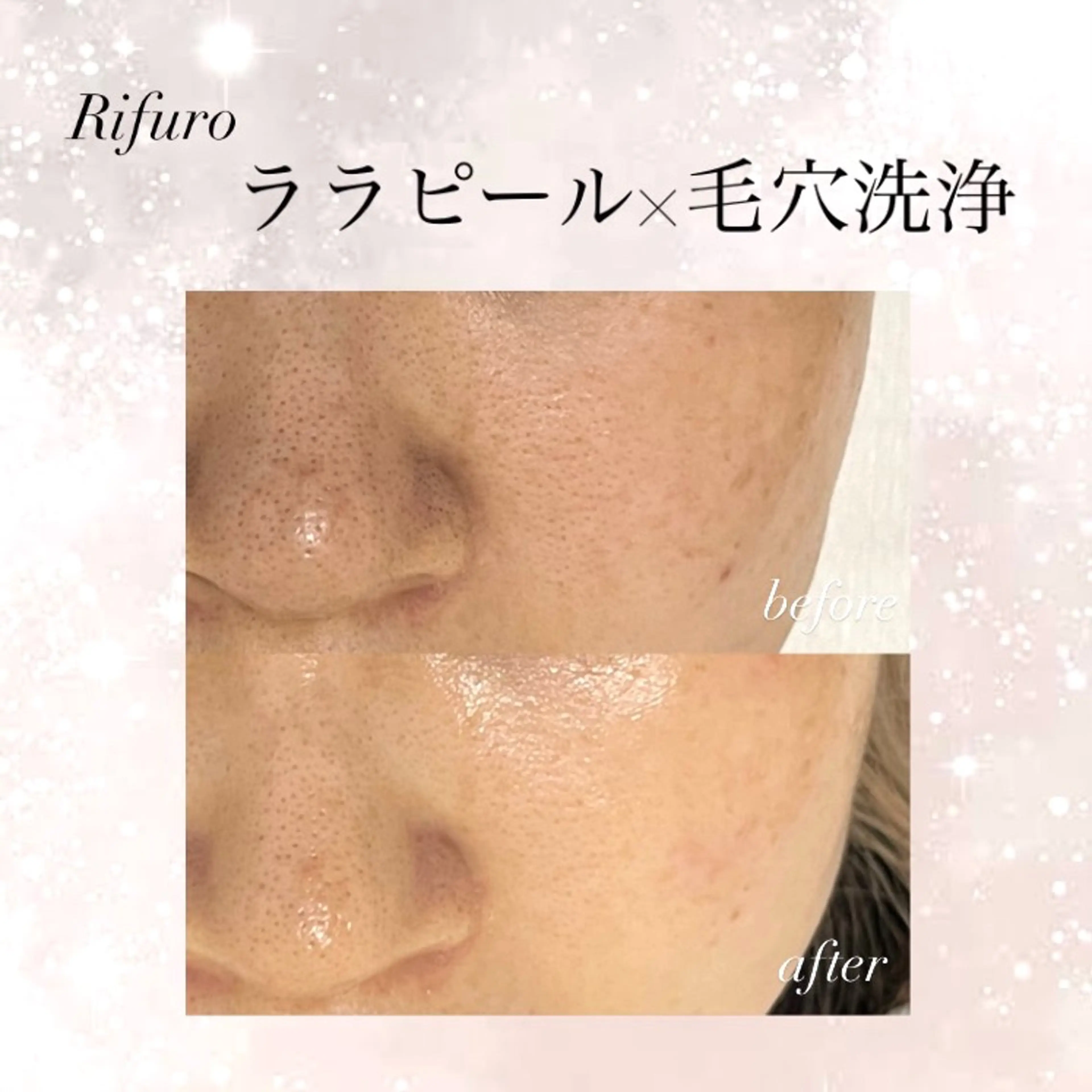 Rifuro 勝田台エステ所属・Rifuro勝田台 ララピール・毛穴洗浄のエステ・リラクイメージ