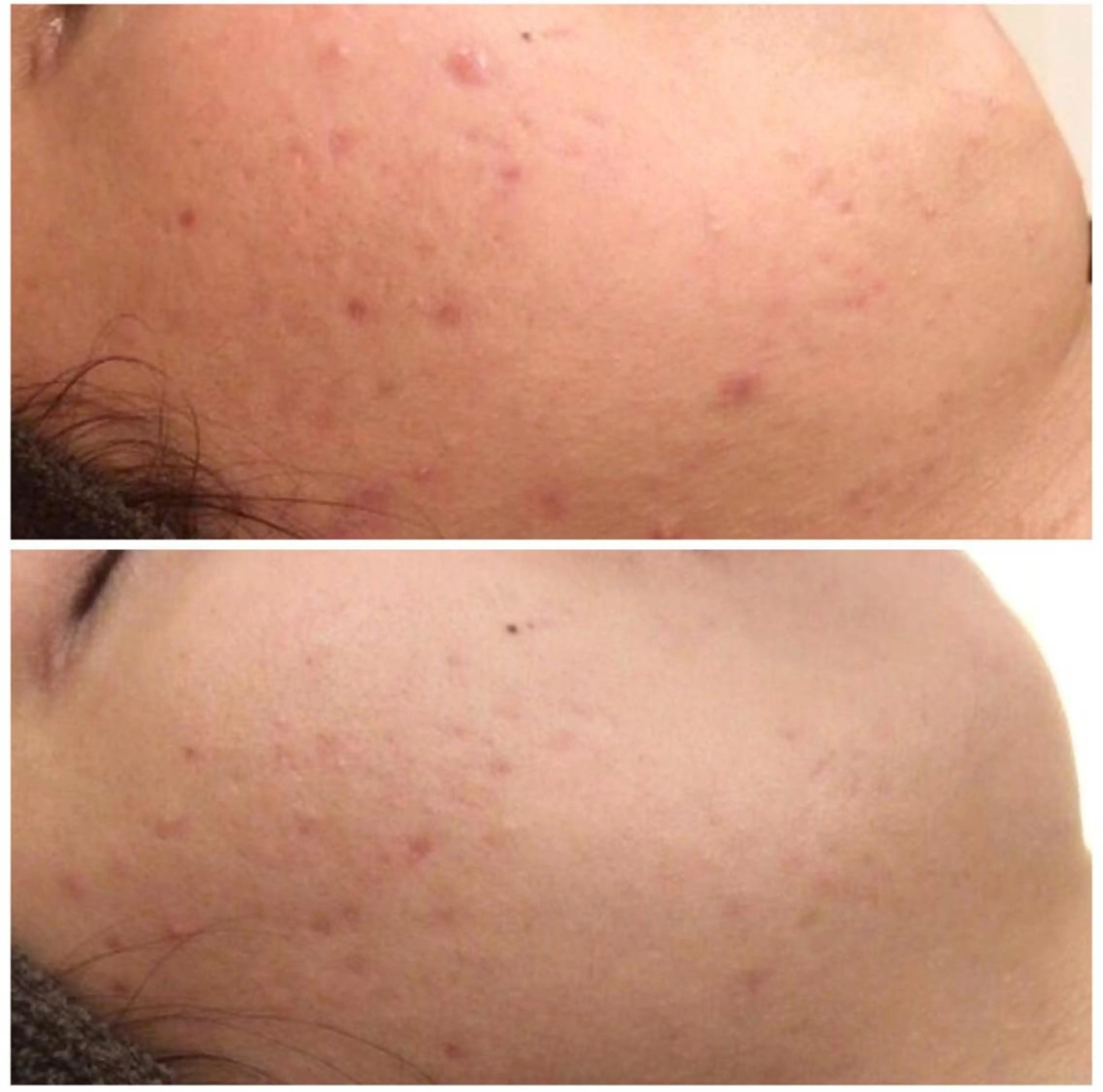 ニキビ跡改善専門🔥 医療にはできない改善のエステ・リラクイメージ