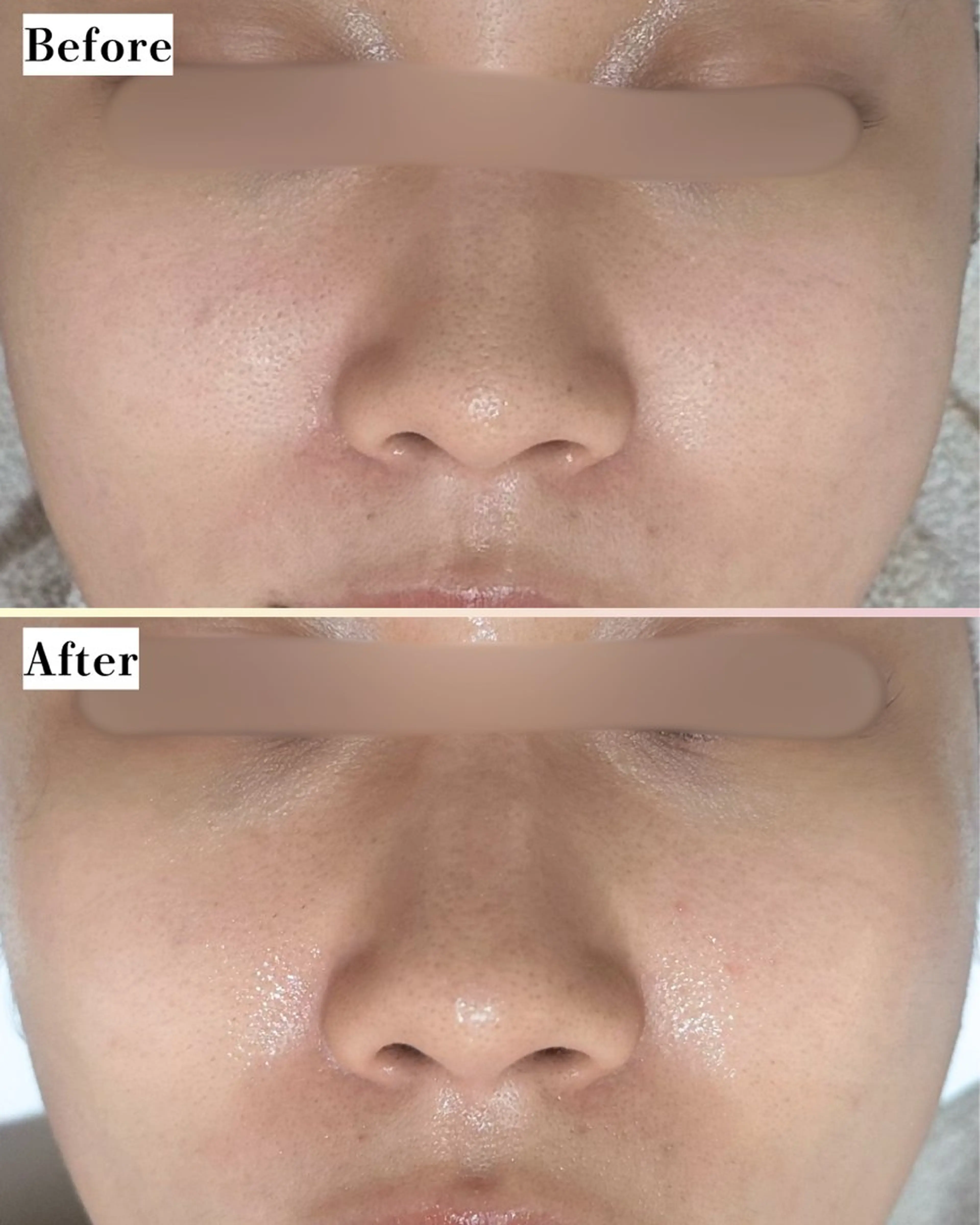 エステ |ピーリング・毛穴| soina神楽坂のエステ・リラクイメージ