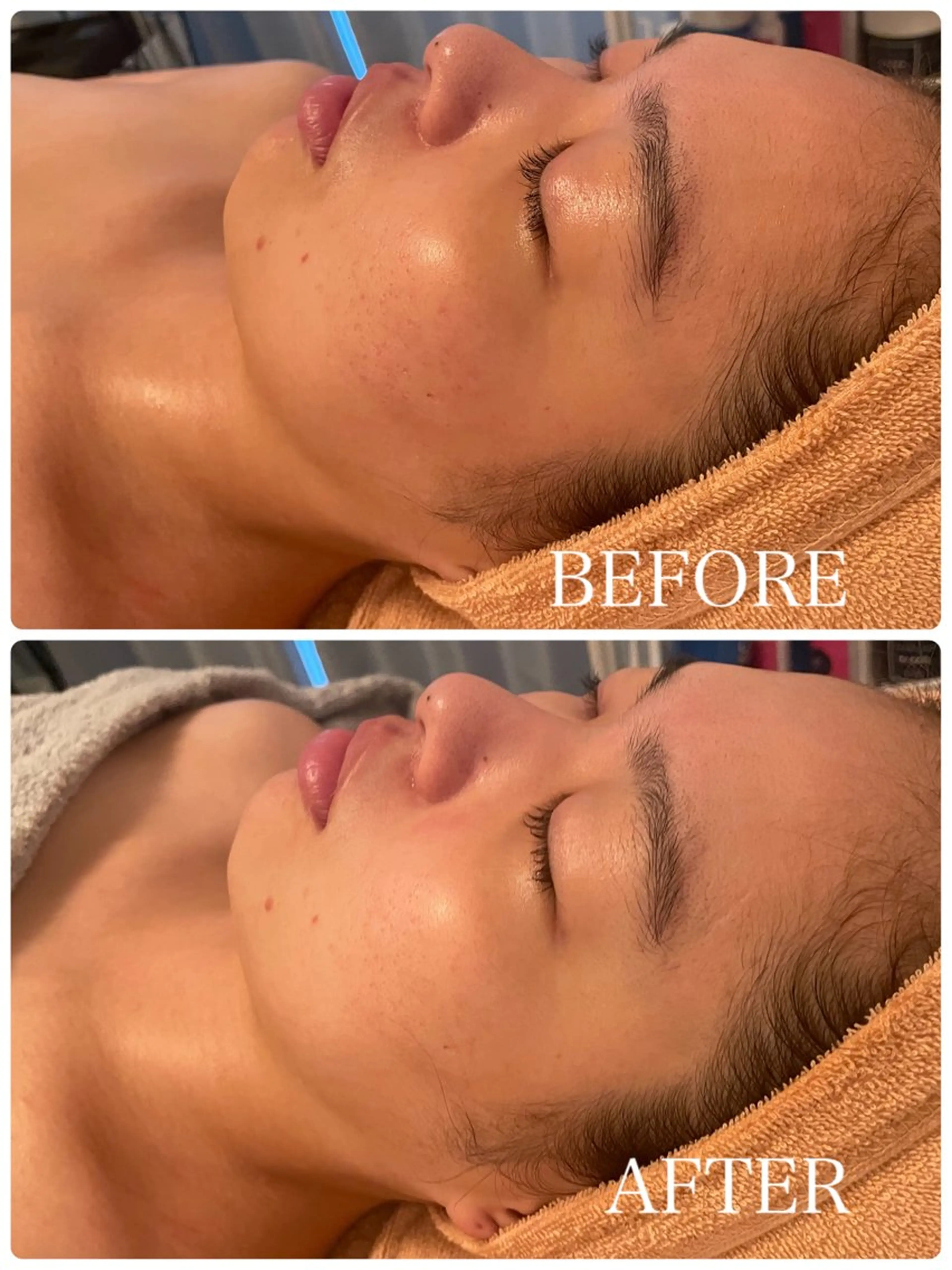 贅沢フェイシャル⭐︎WINBACK＆カーボキシー＆オールハンド60分の写真