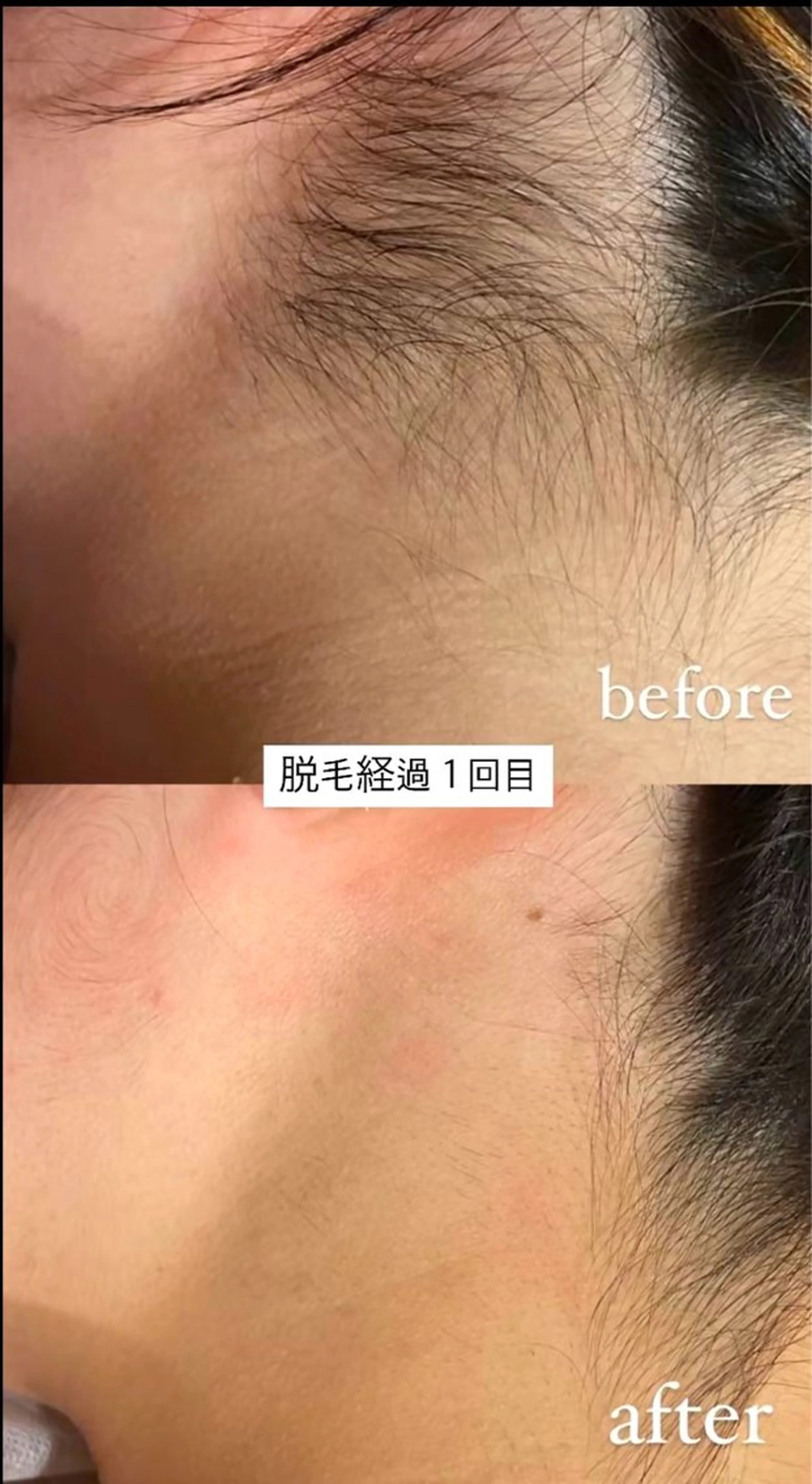 脱毛 メルシー13所属・トータル美容サロン☆ 脱毛/小顔/毛穴洗浄のエステ・リラクイメージ