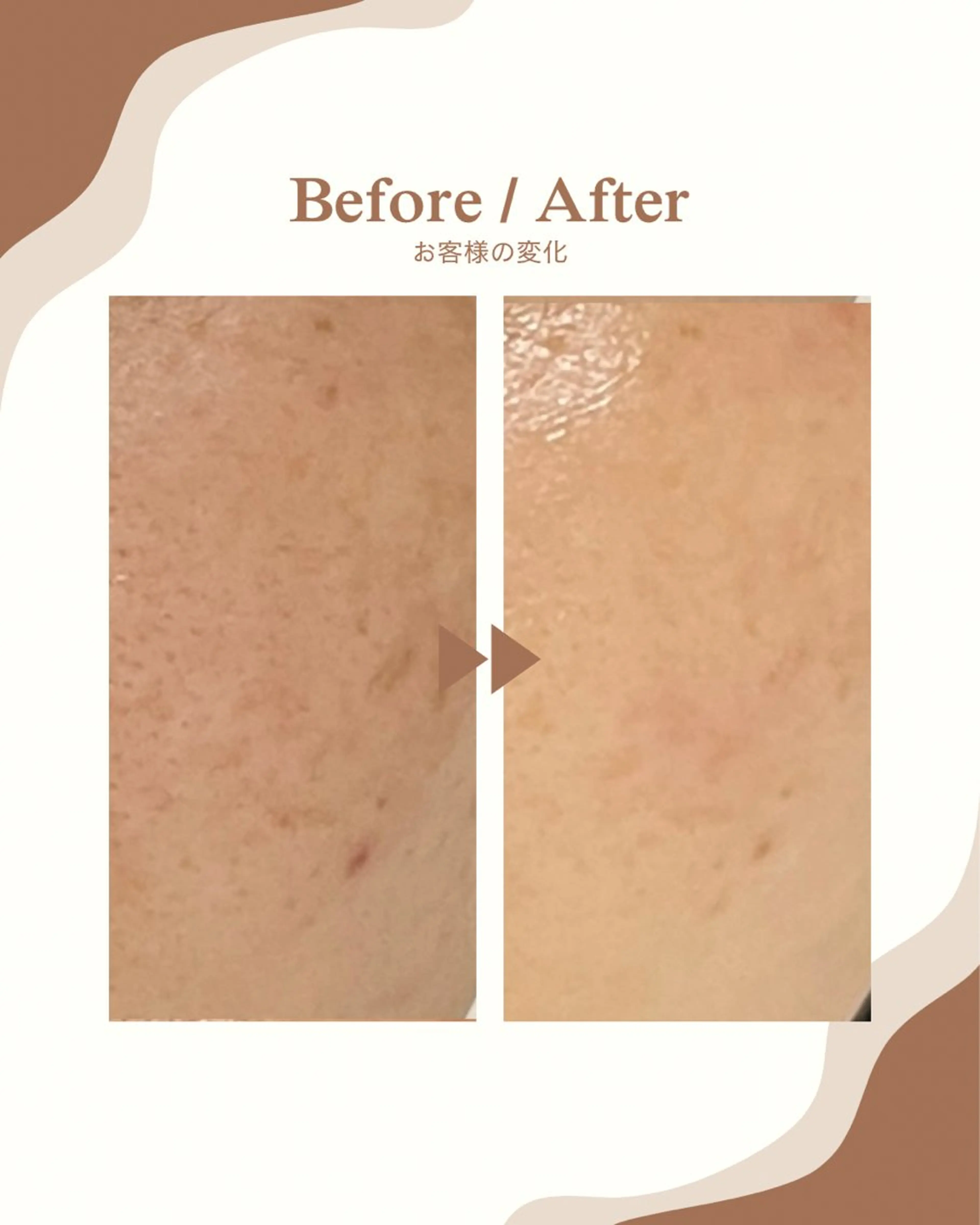 光フェイシャル✨ 12月27.28日限定❗️脱毛も‼️肌お肌悩みを一気に解決❗️毛穴改善・美白ケア・乾燥・肌荒れ改善の写真