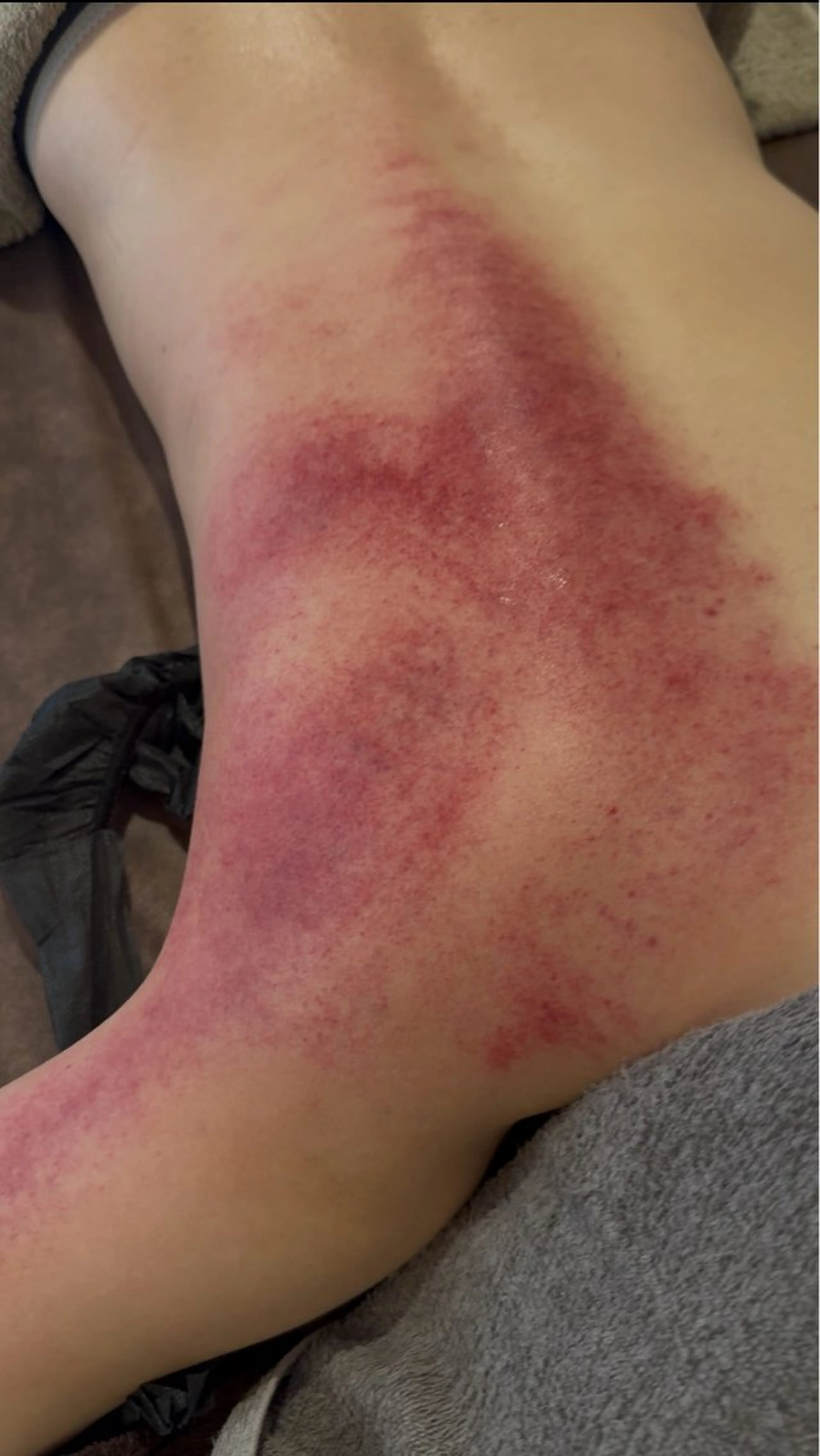 12月限定🎄【上半身】脂肪の原因になるセルライトケア👊💥デトックスマシン デトックストリートメント60分コース🍀の写真