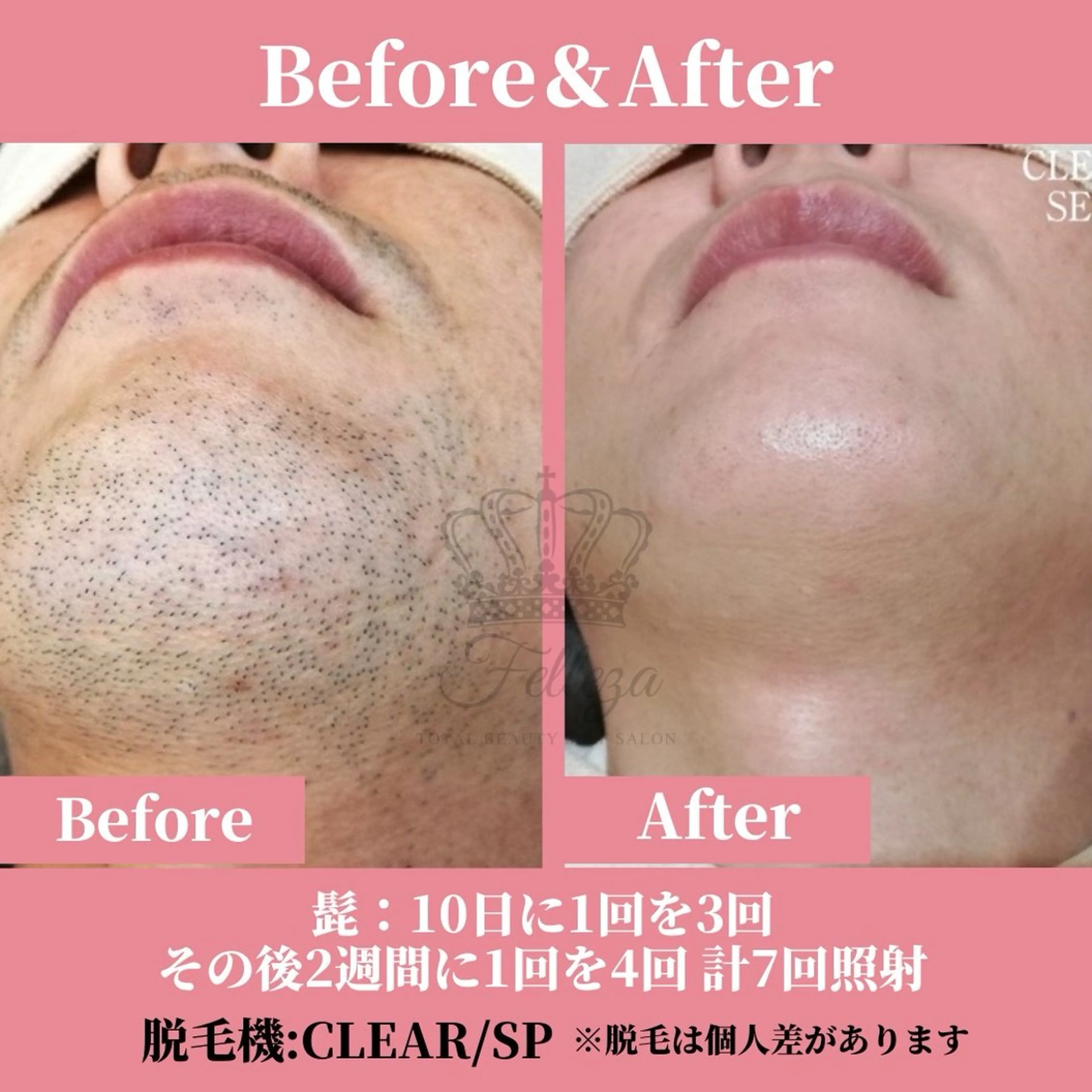 メンズ 有人型セルフサロン 脱毛/痩身/美顔のその他イメージ