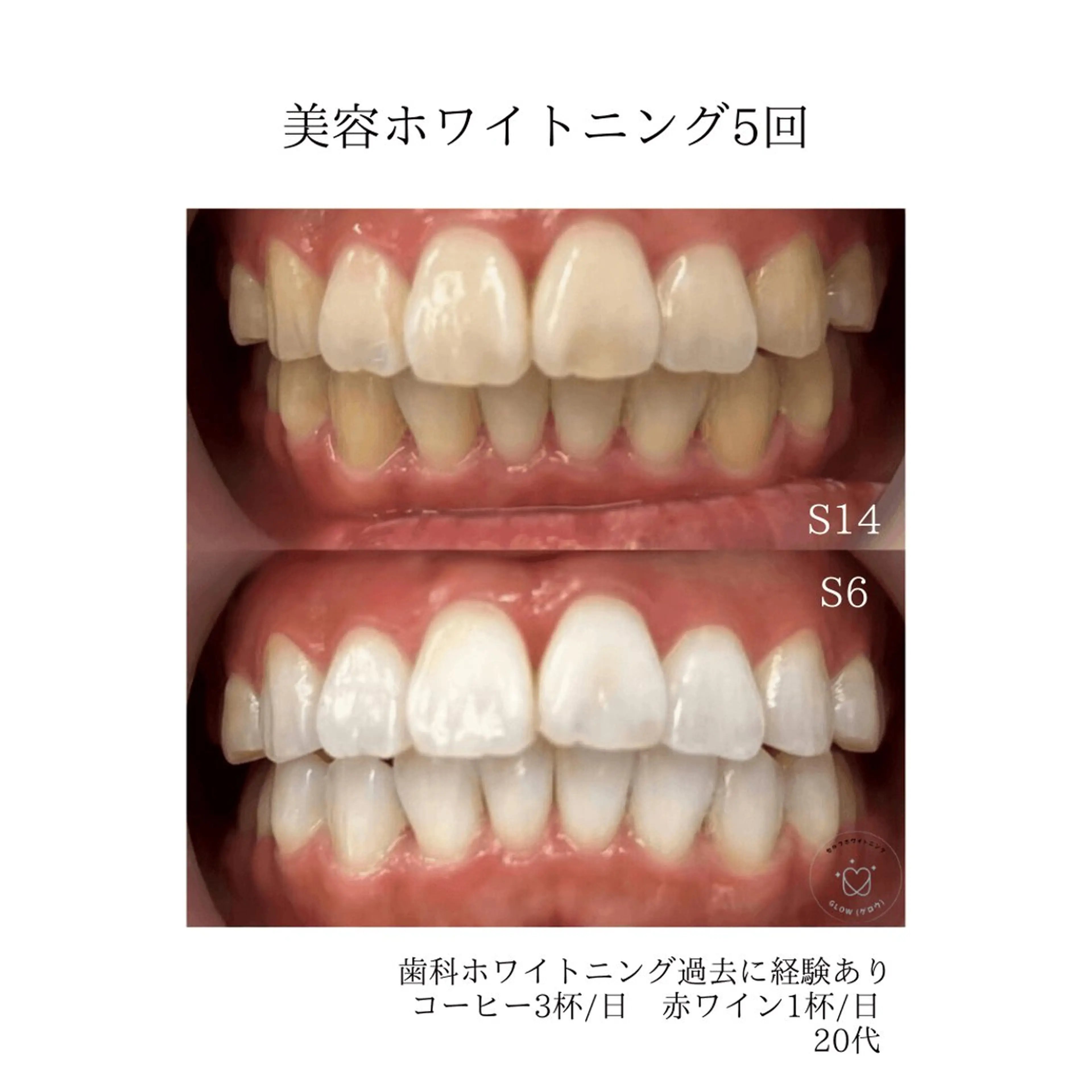 歯のセルフホワイトニング専門店GLOW(グロウ)所属・東区香椎歯のセルフホ ワイトニングGLOWのその他イメージ