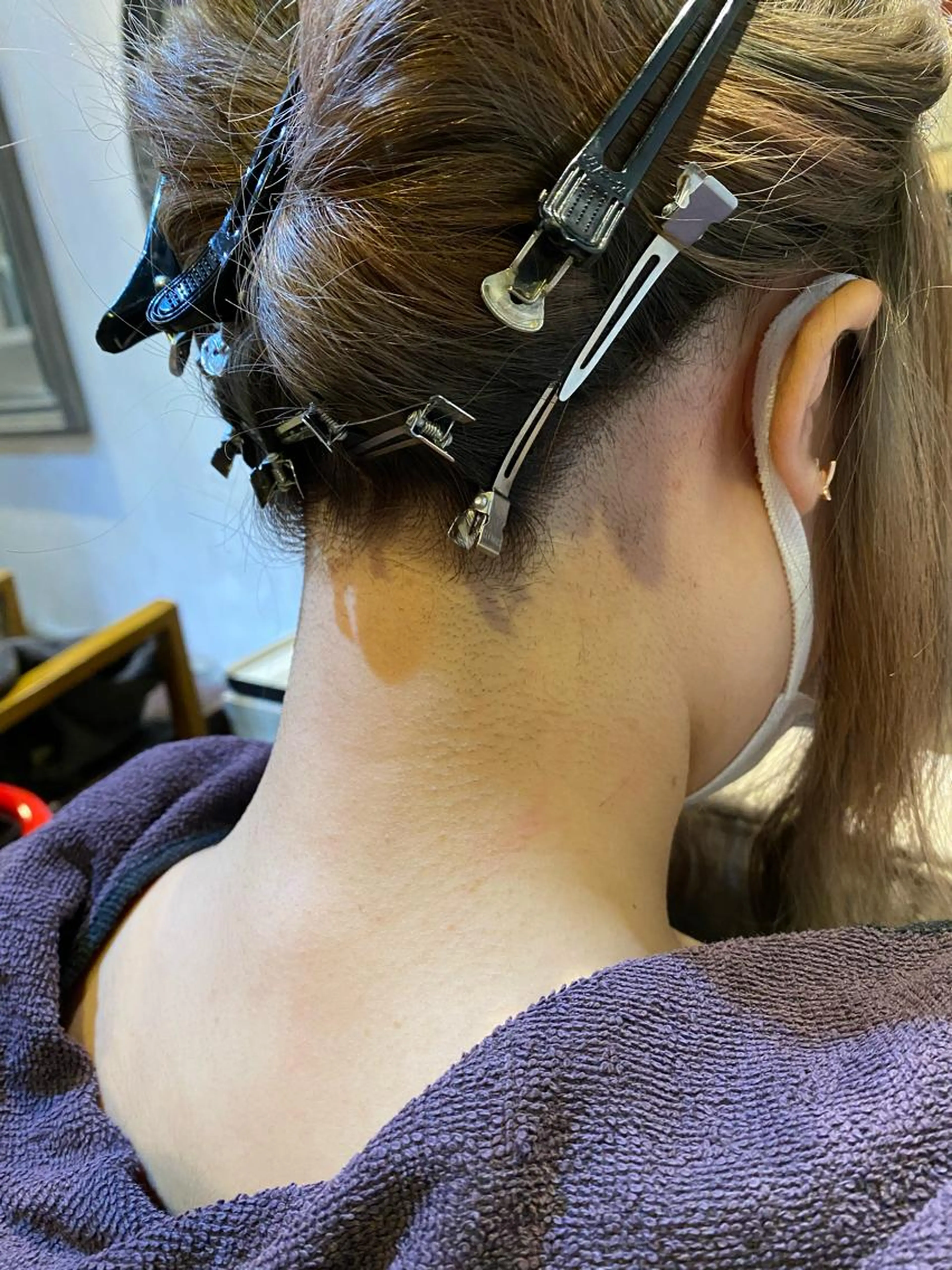 1750円お得✨【７回コース】うなじ脱毛の写真