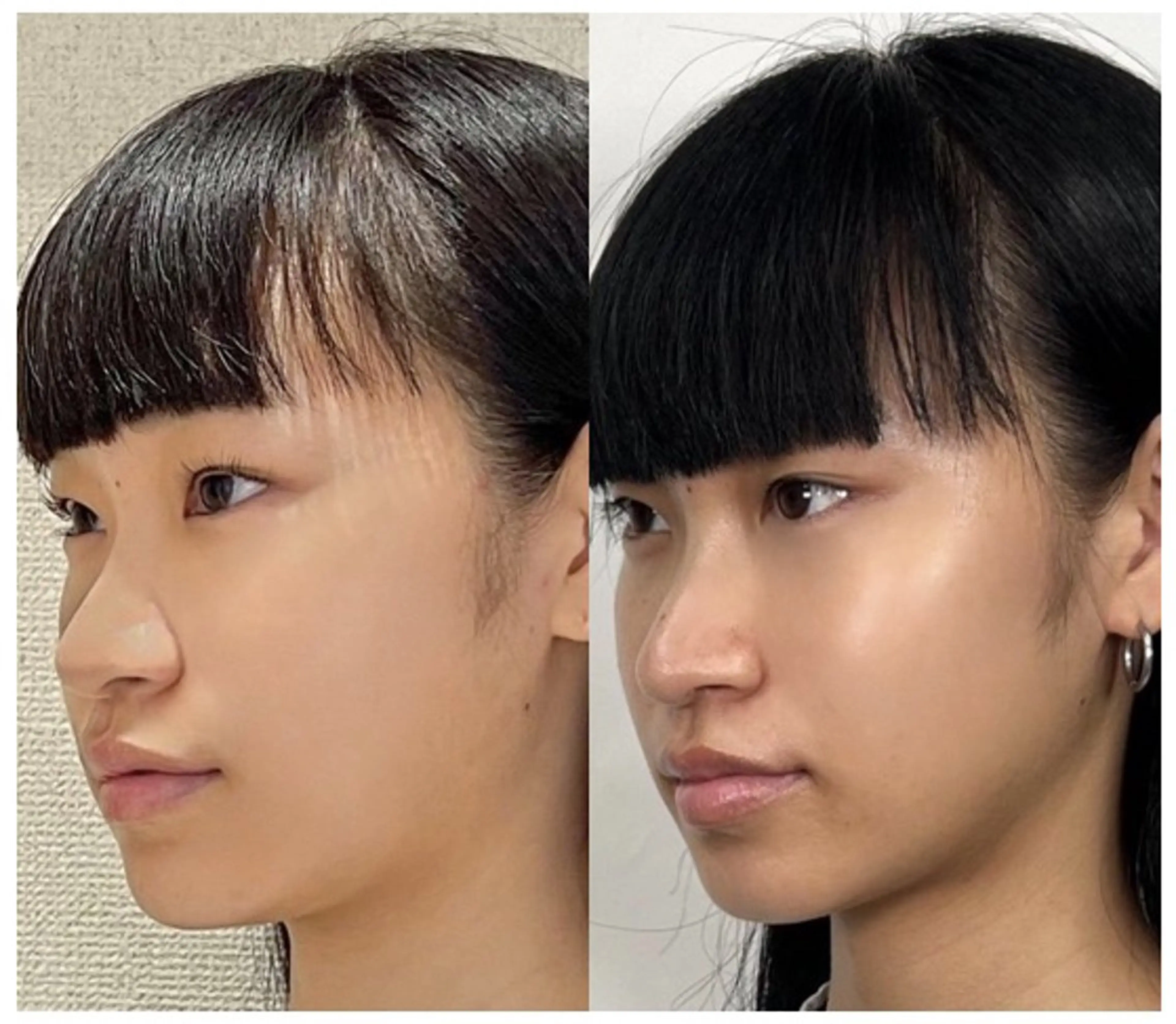 エステ ✨隆鼻矯正✨ 田村のエステ・リラクイメージ