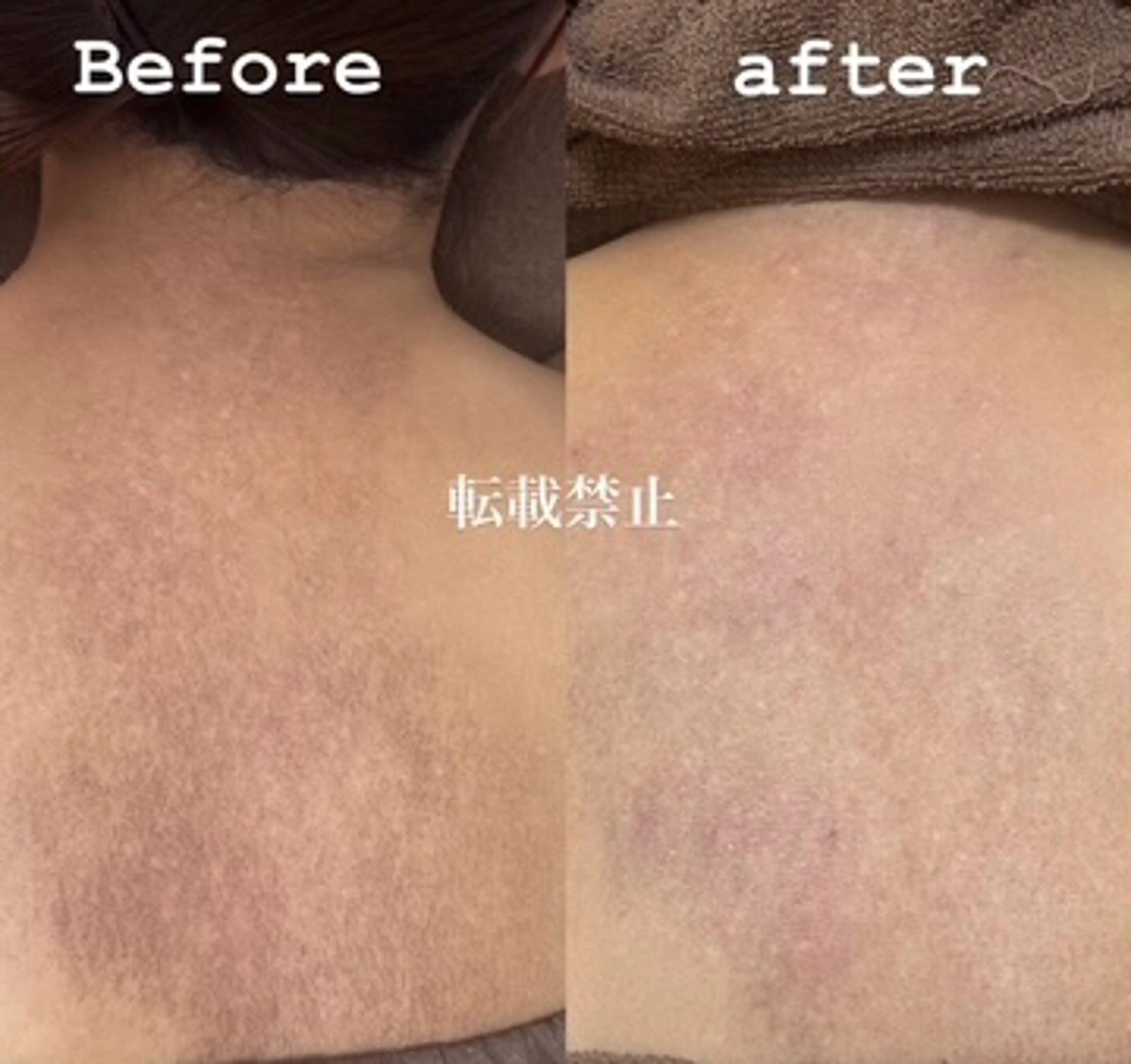 【剥離あり⚠️】ボディーハードハーブピーリング一箇所✨16000円の写真