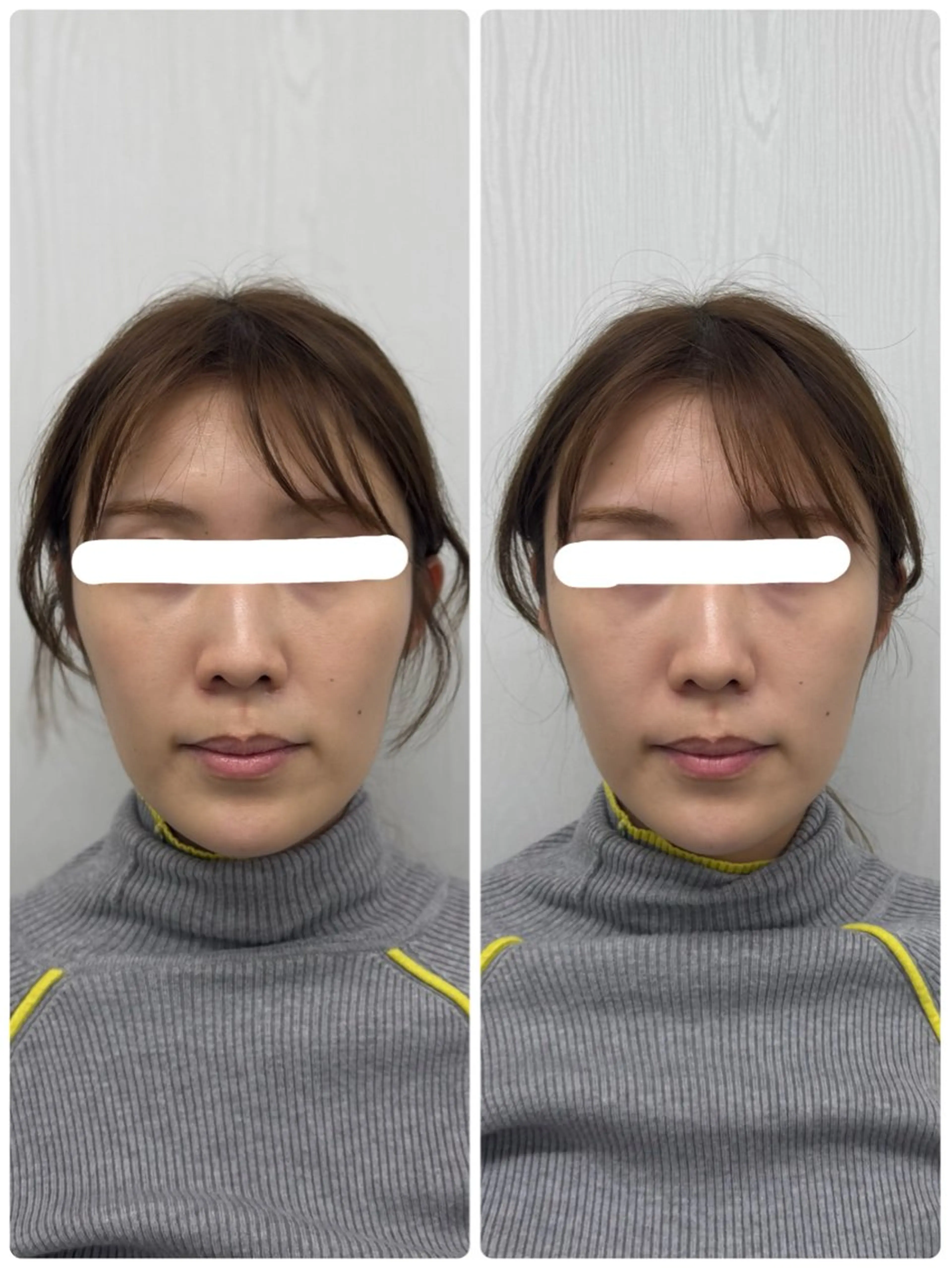 美容鍼×小顔矯正 ×美容整体　浜川泰仁のエステ・リラクイメージ