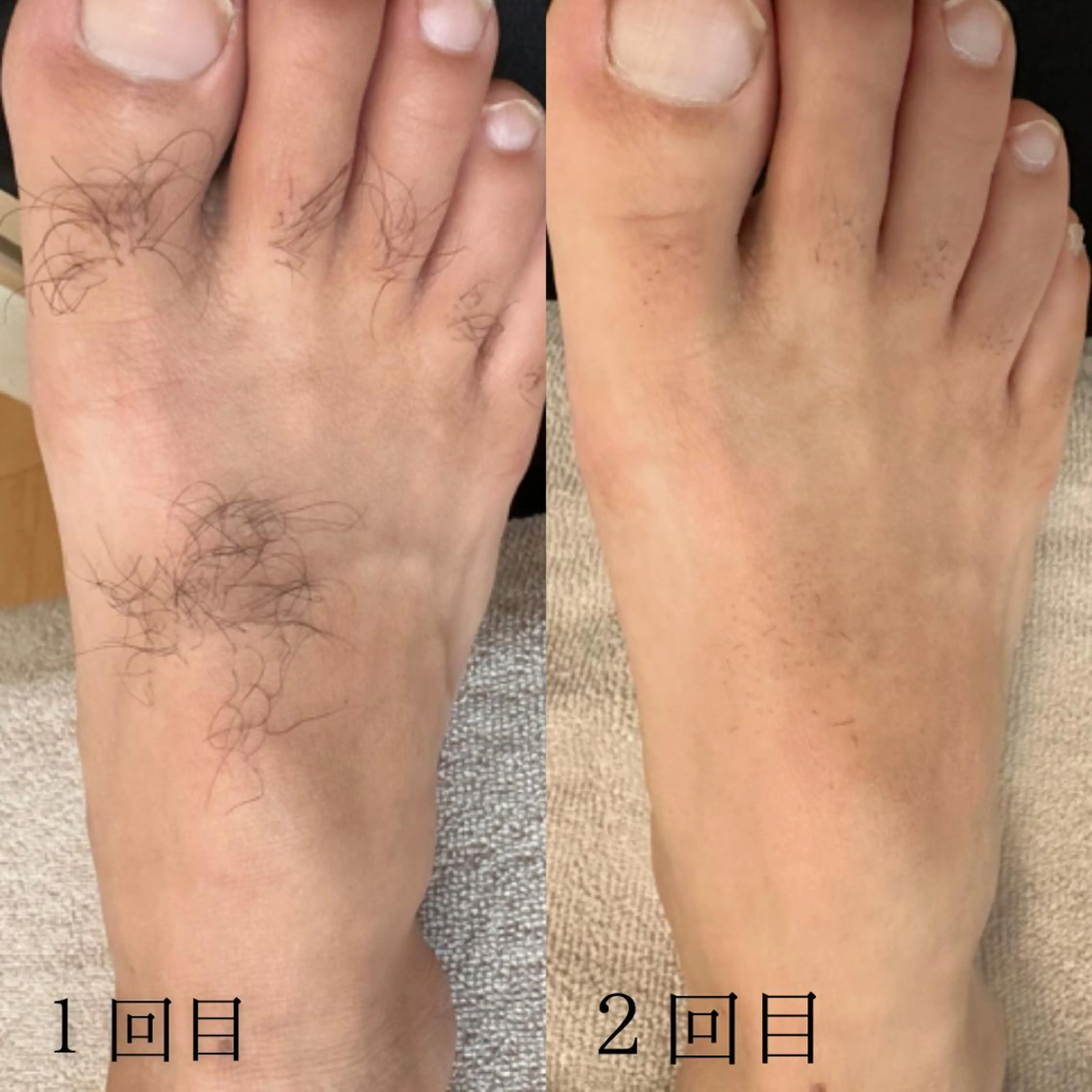 脱毛SSパーツ【口周り/乳輪周り/へそ周り/両手指甲/両足指甲】の写真