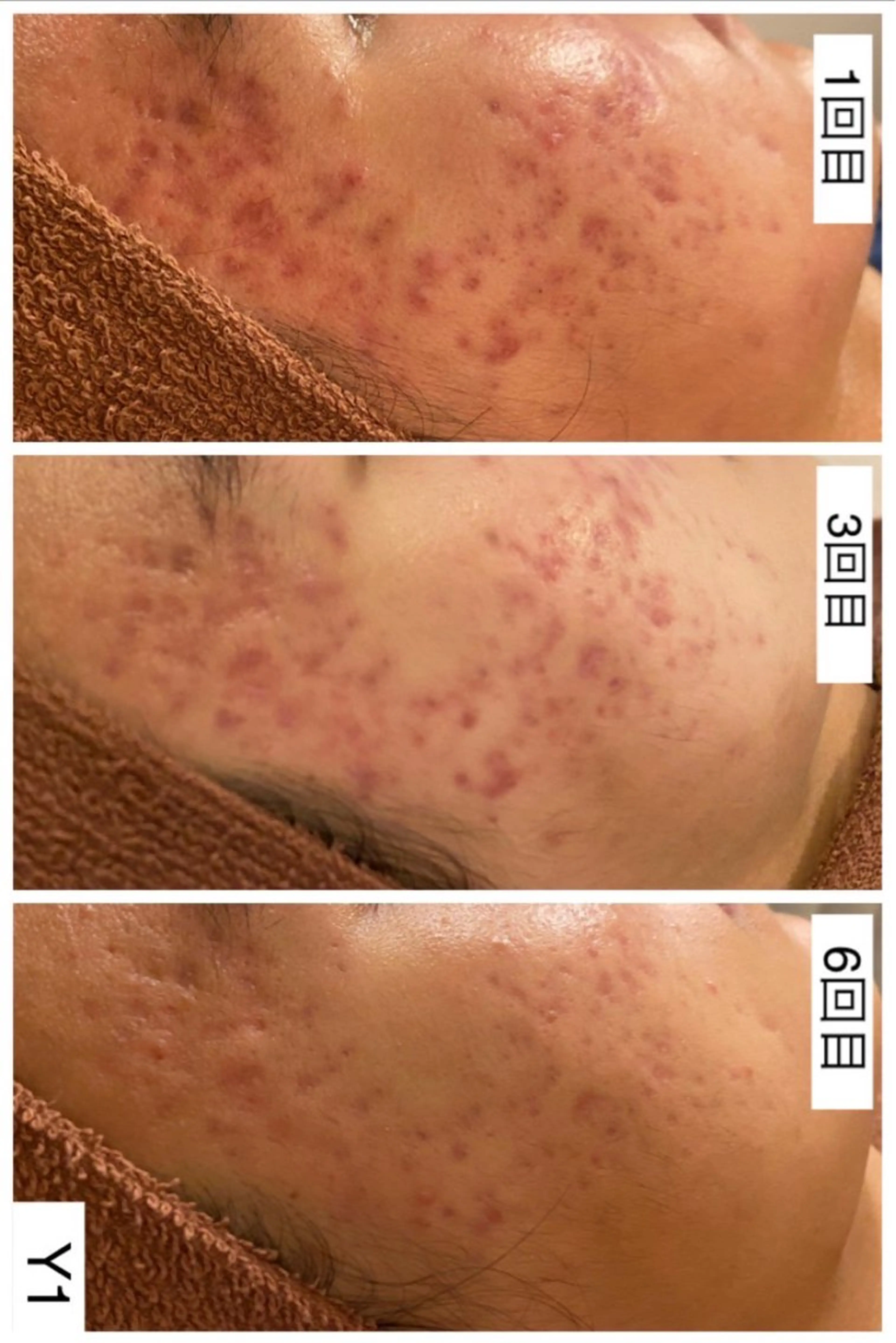 ニキビ跡改善専門🔥 医療にはできない改善のエステ・リラクイメージ