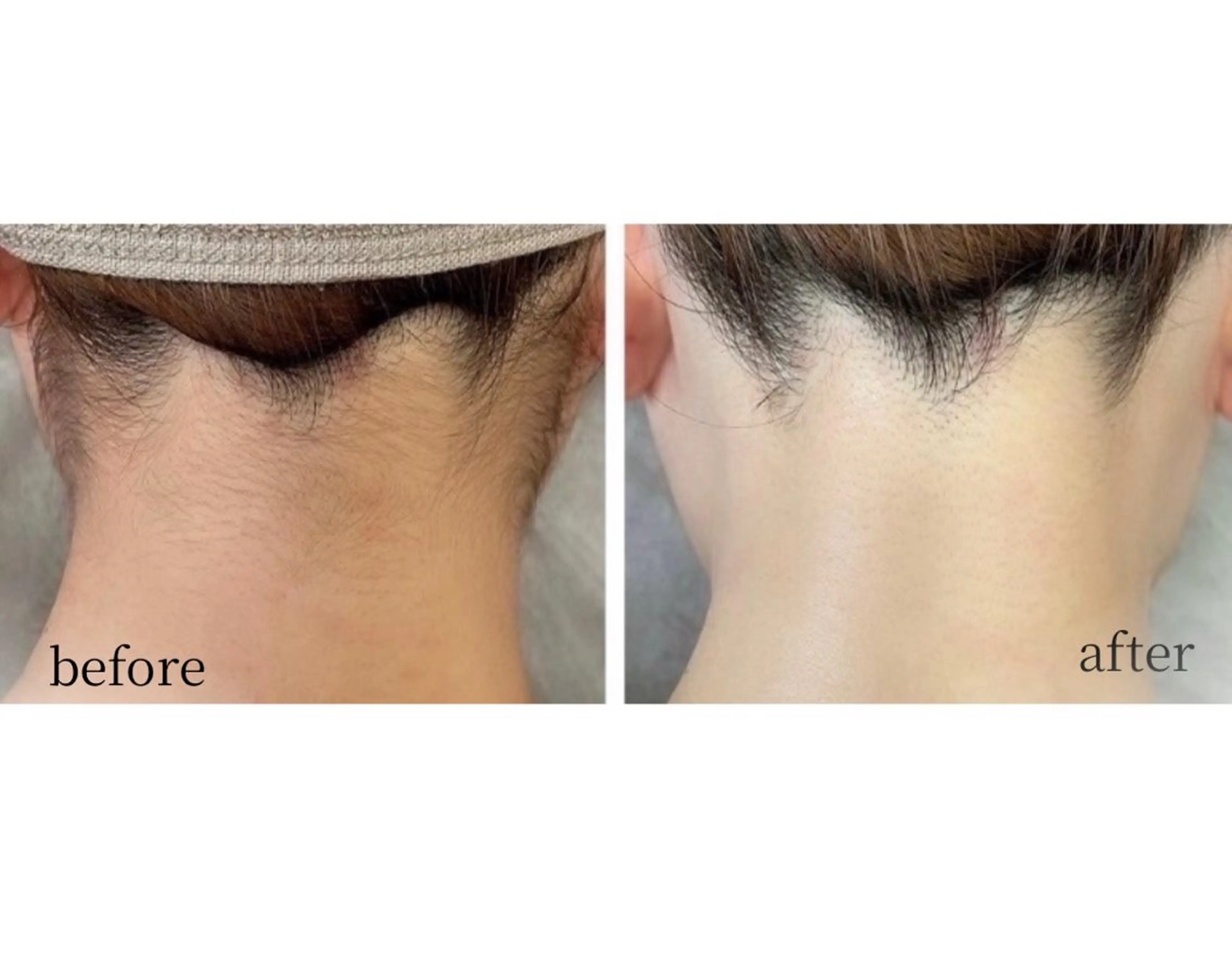 【地域最安値】【先着15名様→残り9名様】全身脱毛(顔+VIO込)の写真