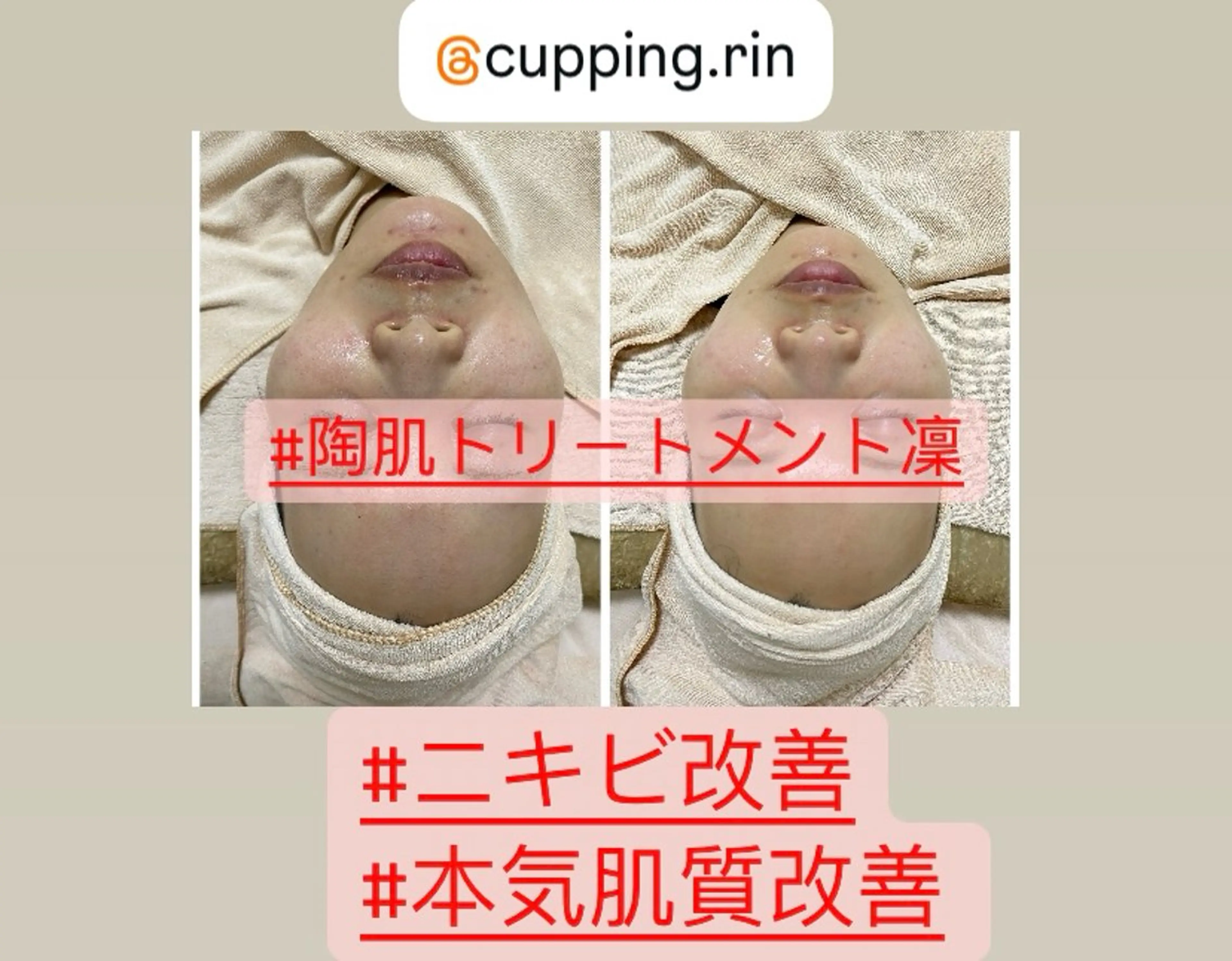 BBグロー+カッサ小顔+陶肌(贅沢コース)お肌悩み一気に改善❣️(マミ割)の写真