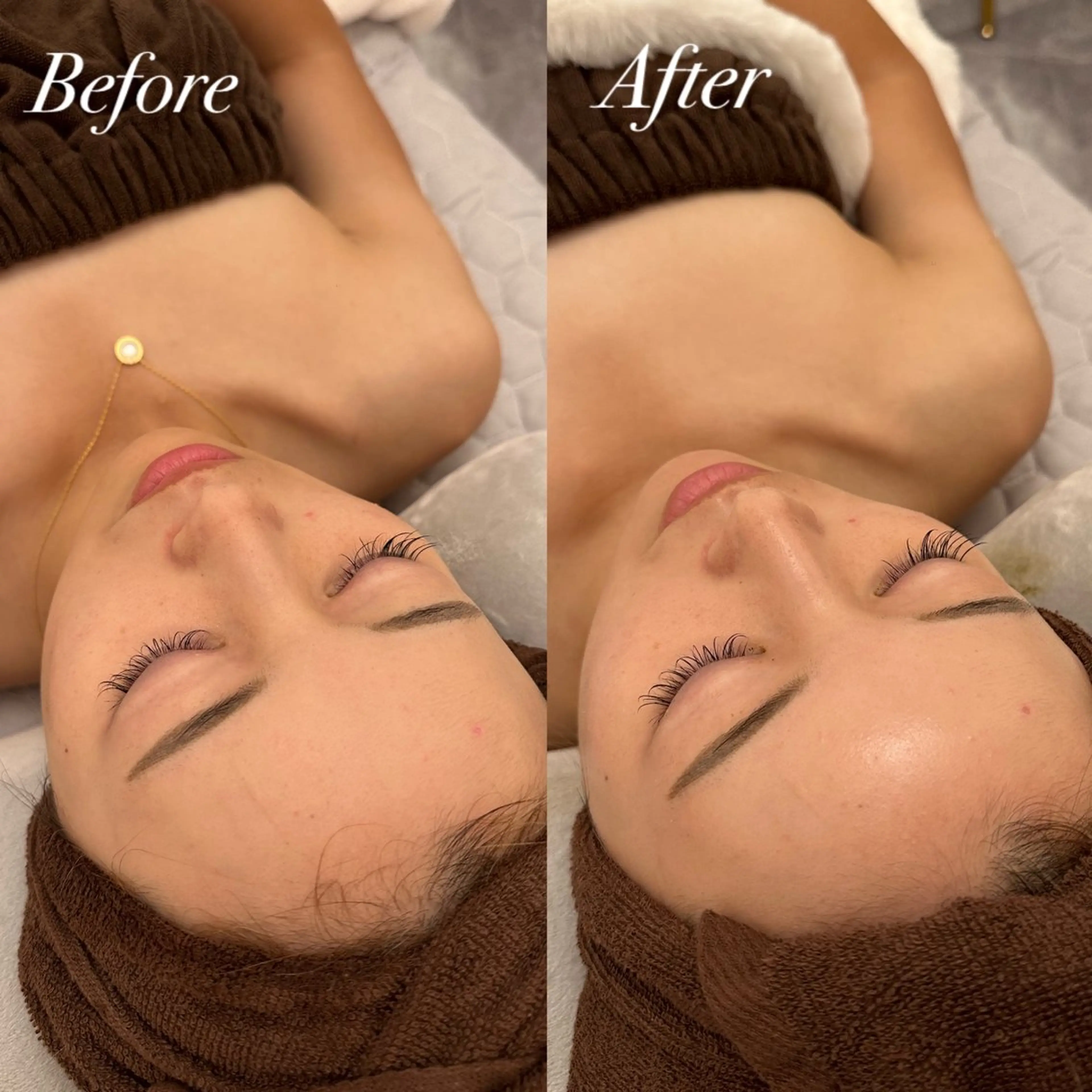 REVIハーブピーリング　全顔の写真