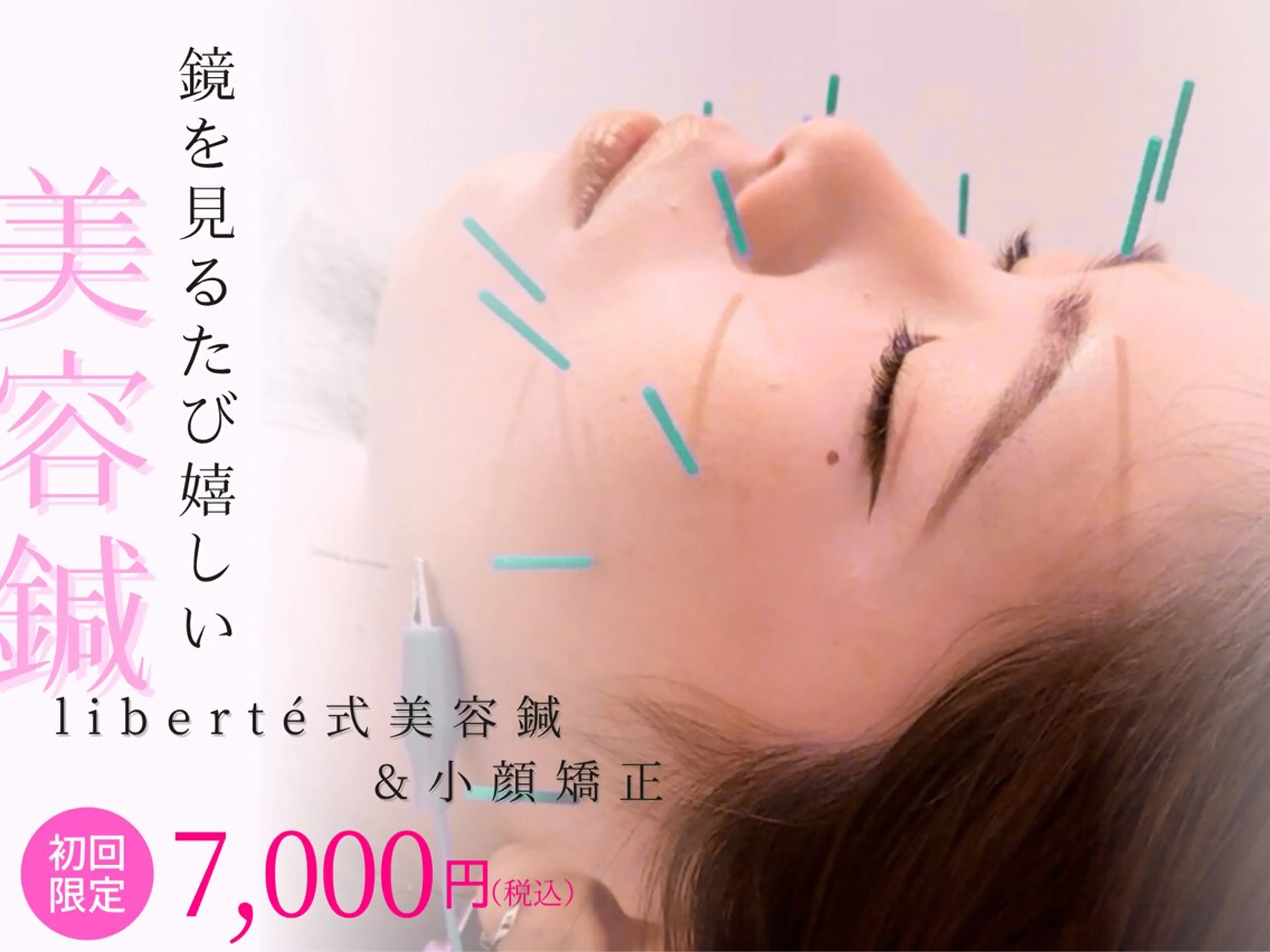 【たるみ・むくみに】美容鍼＋小顔矯正 ¥7,000の写真