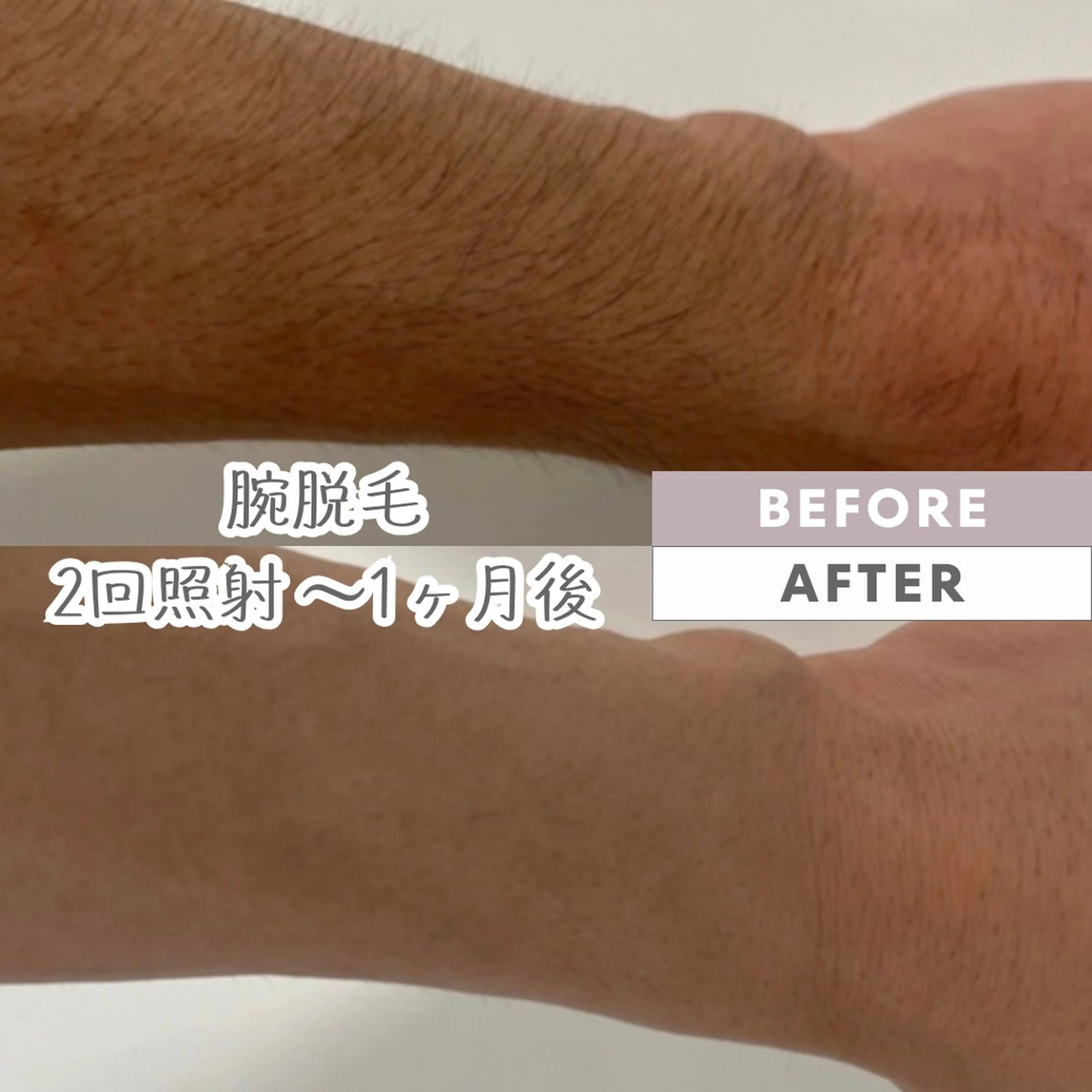 脱毛 脱毛｜ピーリング ROOM.Sのエステ・リラクイメージ