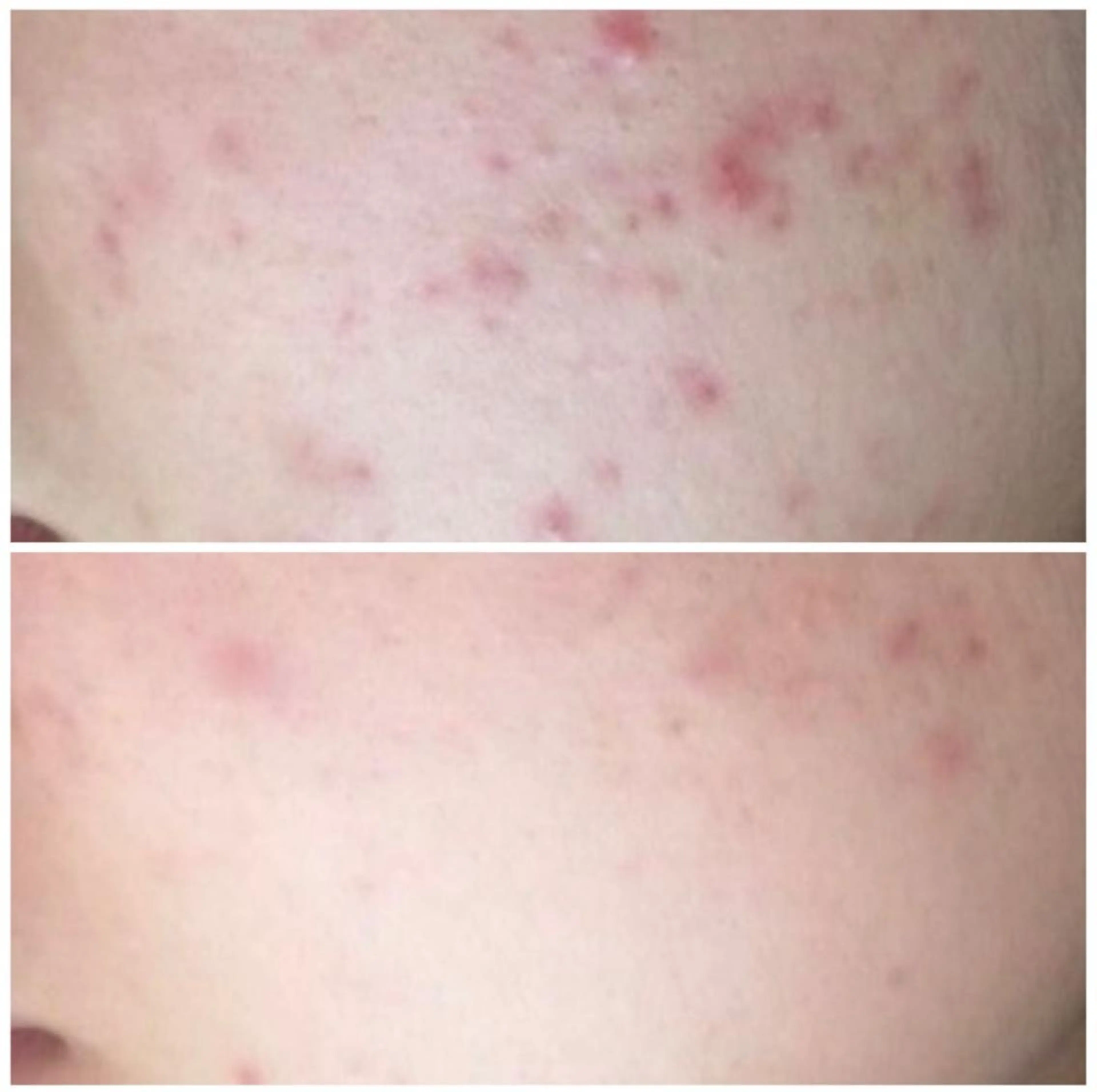 夏までに肌荒れ卒業 するサロン🌻のエステ・リラクイメージ