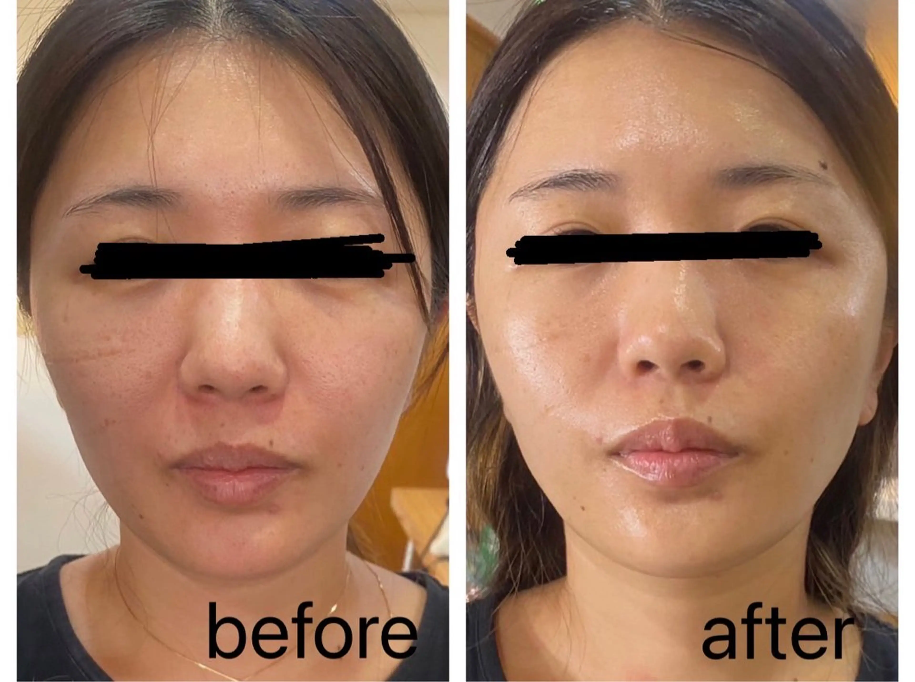 スーパーリフトアップコース✨✨の写真