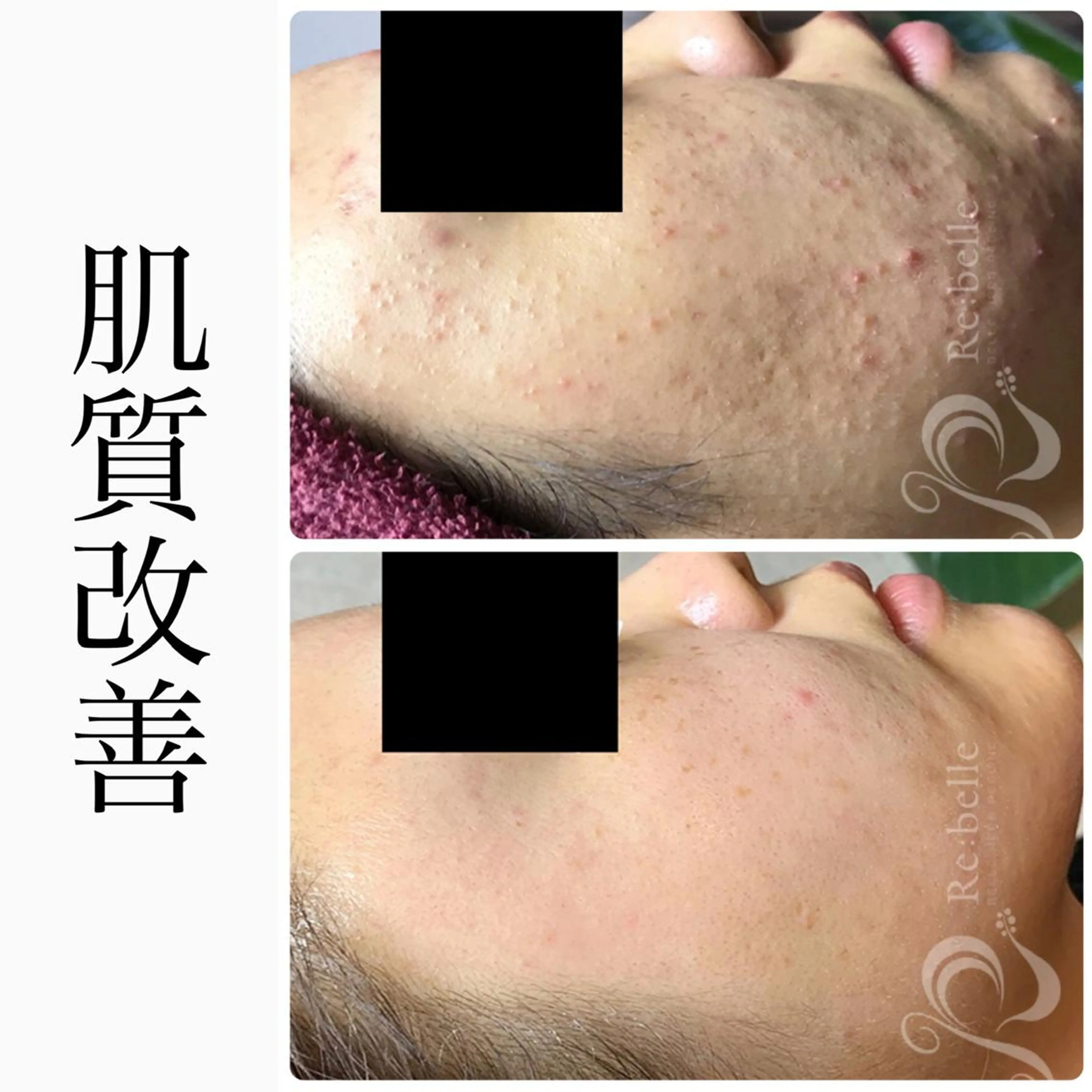 エステ BeSkin藤沢店所属・ニキビ/肌質改善 BeSkin 藤沢店のエステ・リラクイメージ