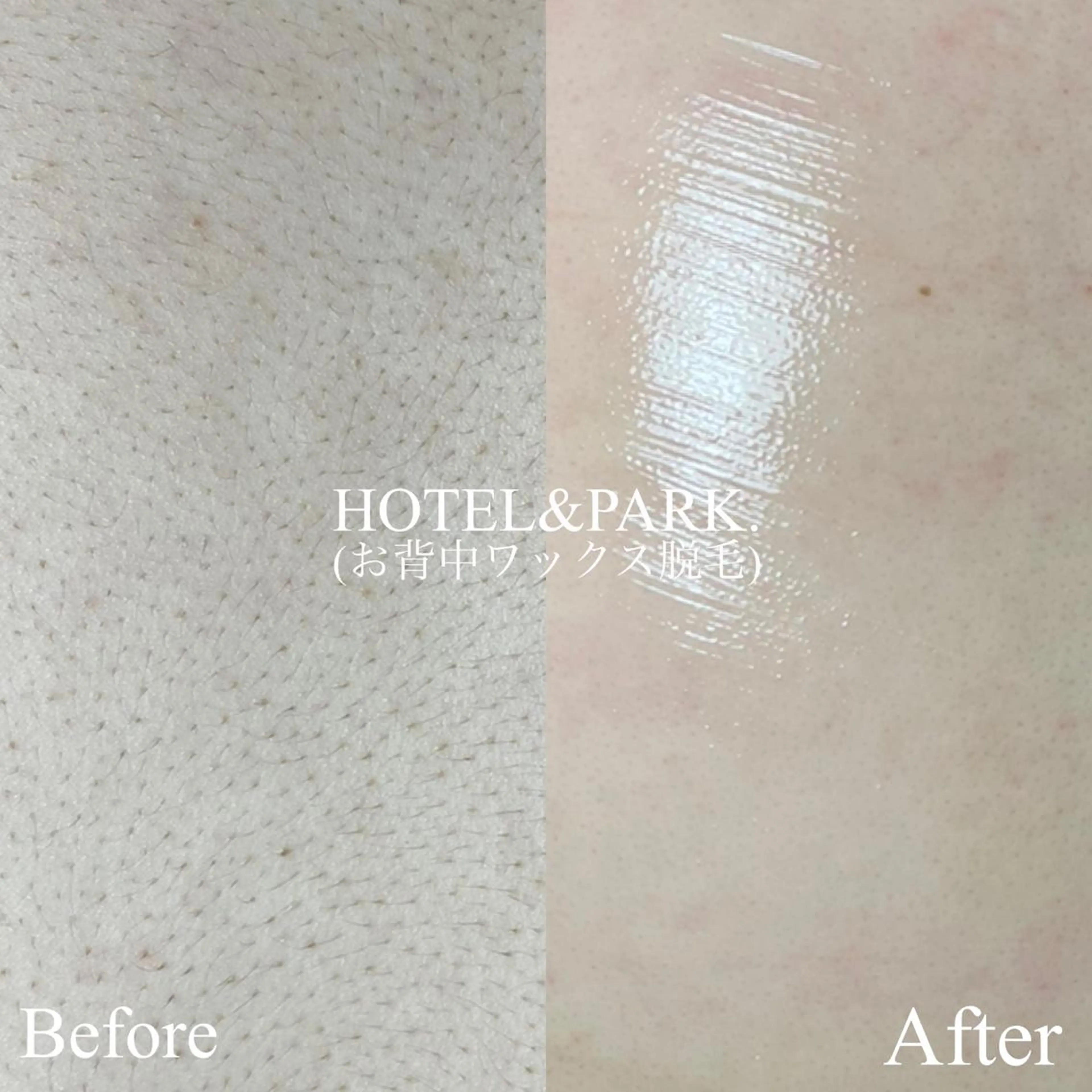 HOTEL&PARK . ワックス脱毛のエステ・リラクイメージ