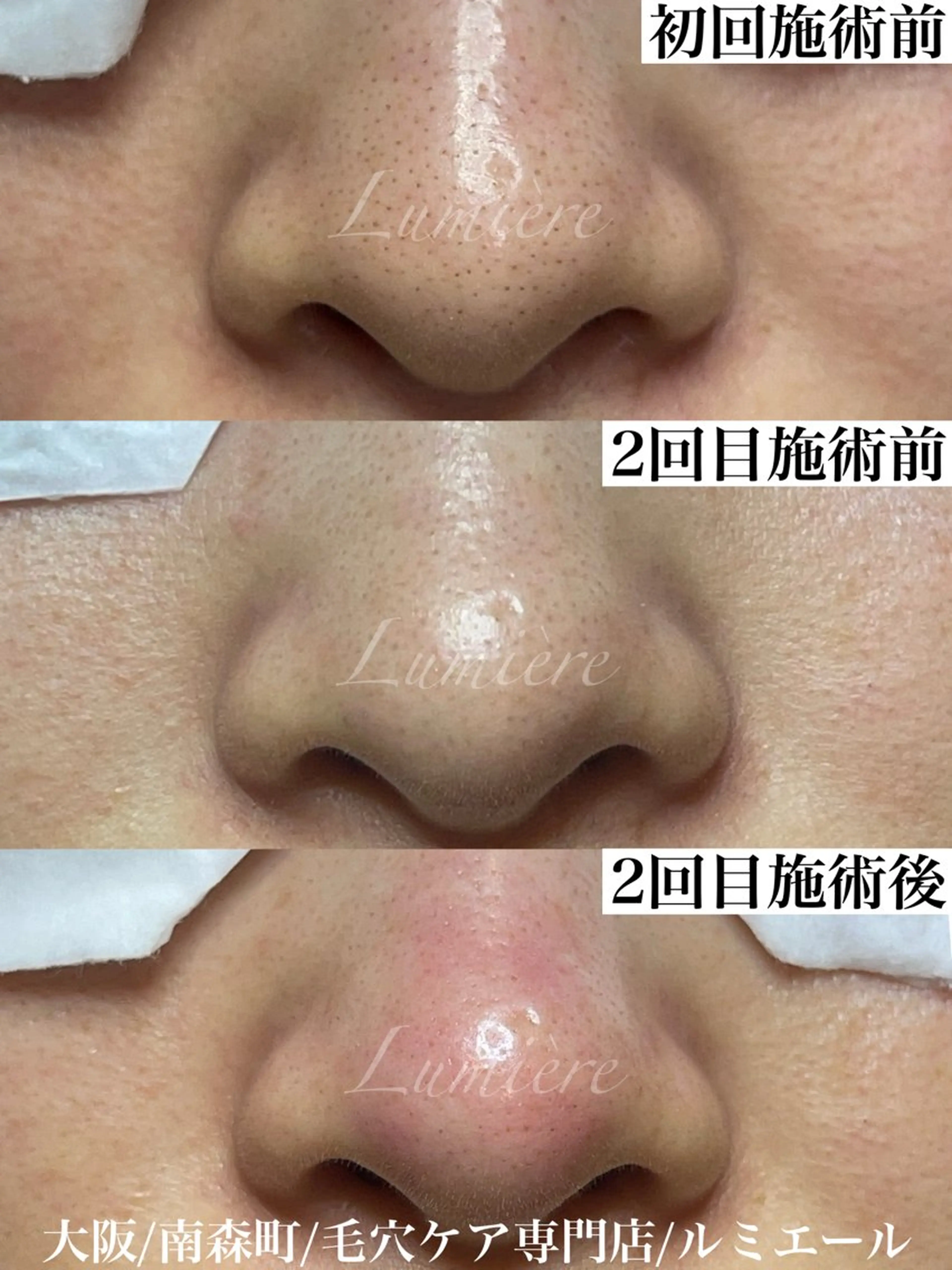 【初回限定モニター】毛穴エクストラクション×フェイシャルマッサージ＆その場で作る生パック付き💆‍♀️つるん肌実感コースの写真