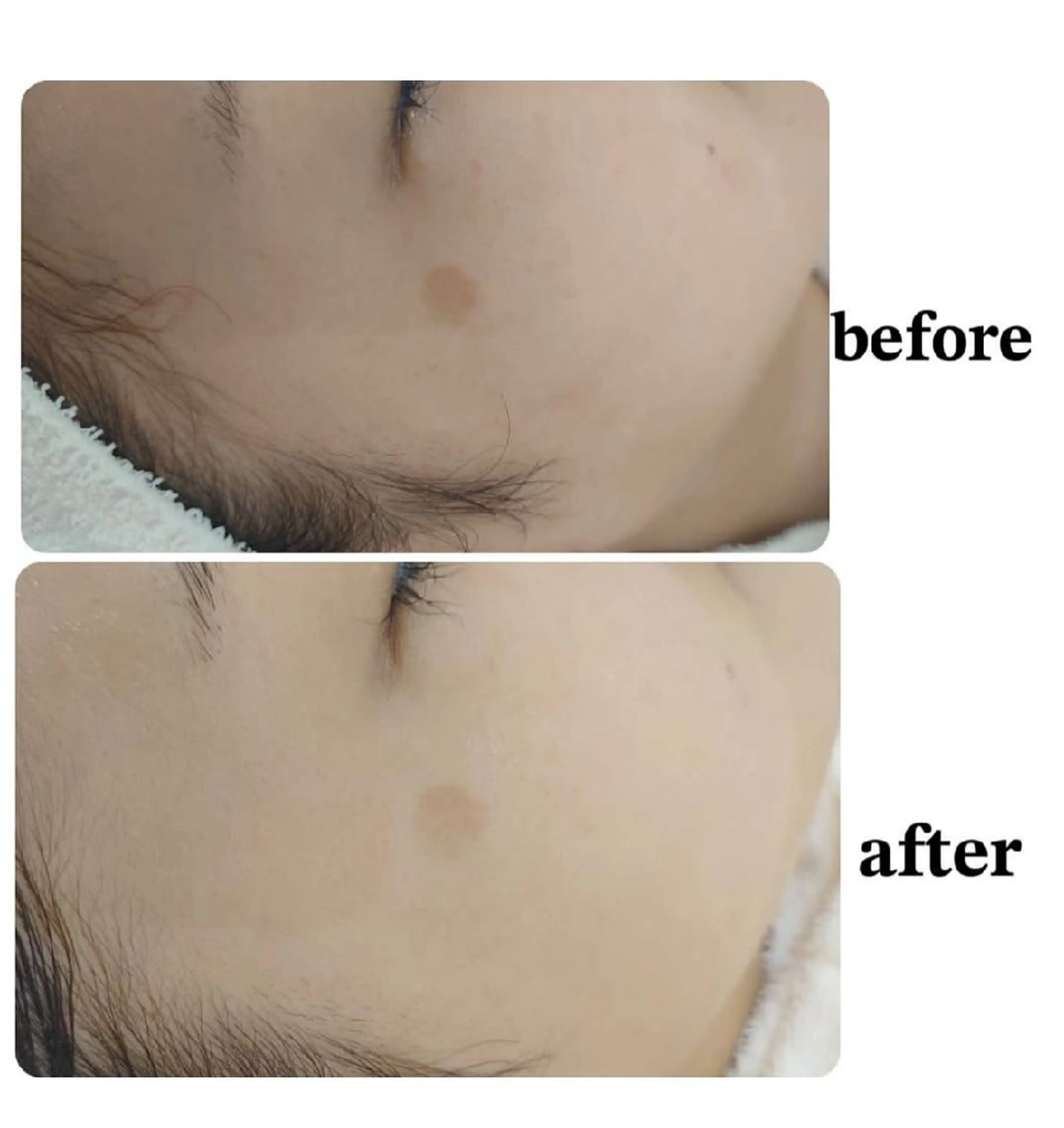 シミ・透明感Upコースの写真