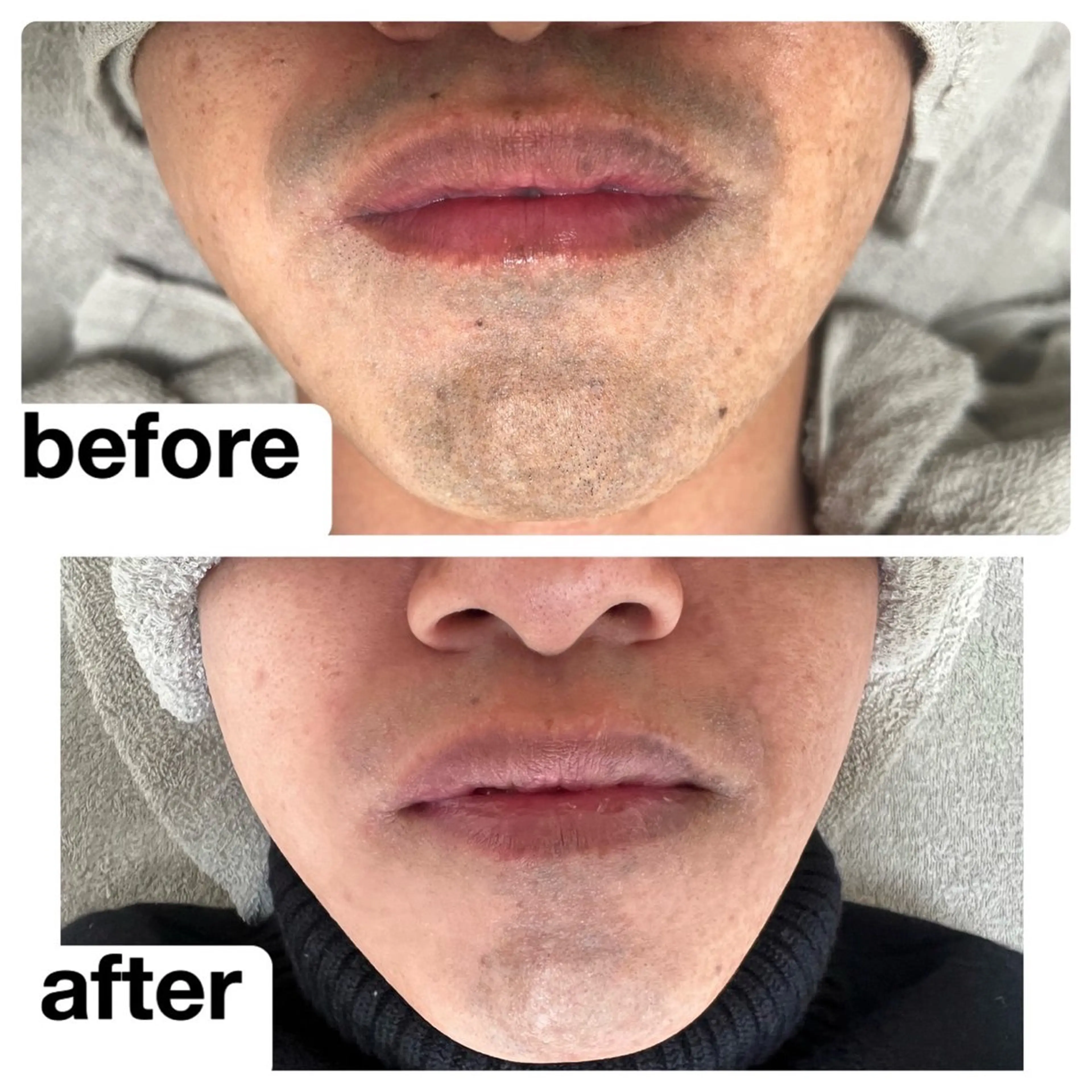 ヒゲ脱毛の写真