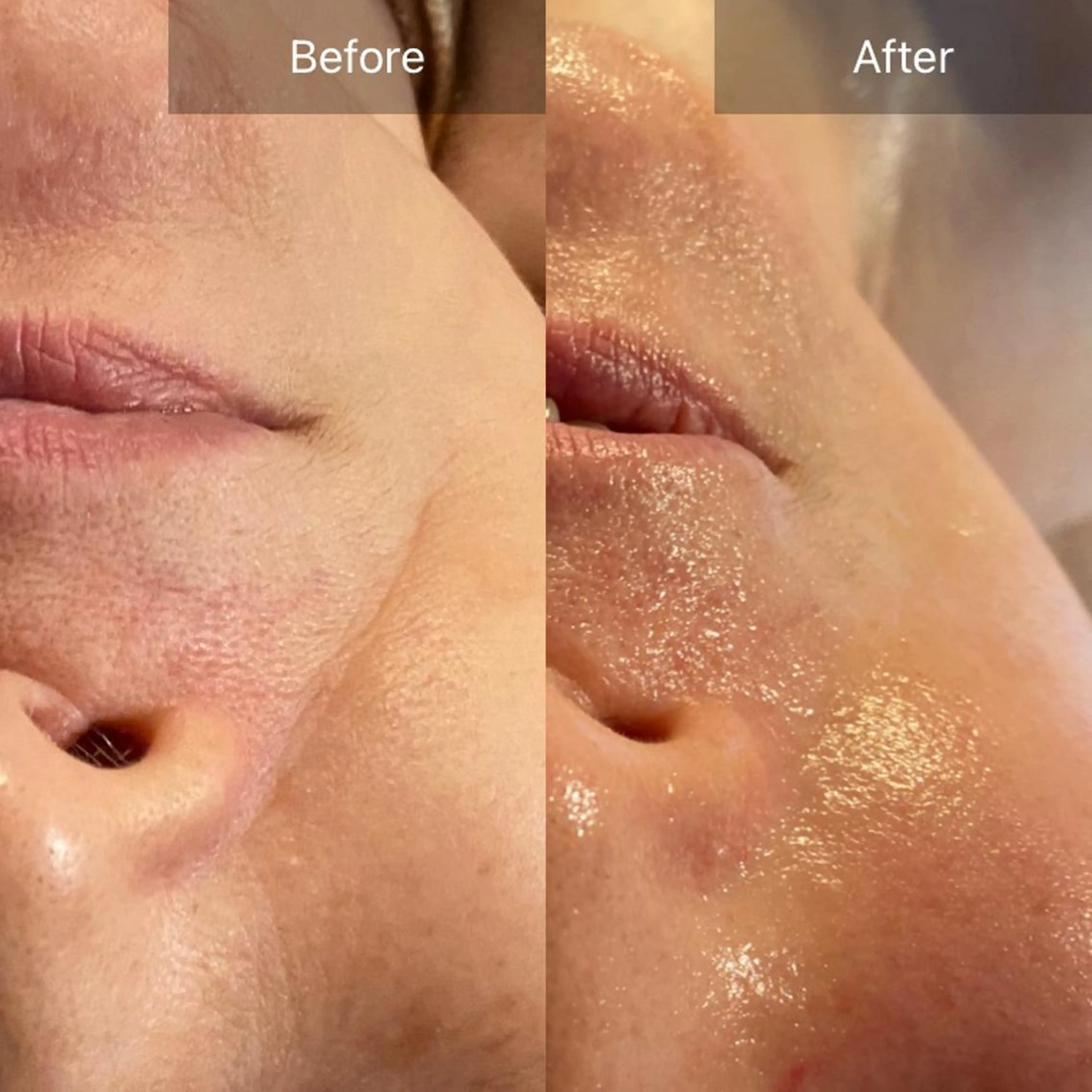 奇跡のメソッド❤️目の下シワ&法令線のない10年前の私へ【生コラーゲン注入コース】お茶カウンセリング込140分の写真