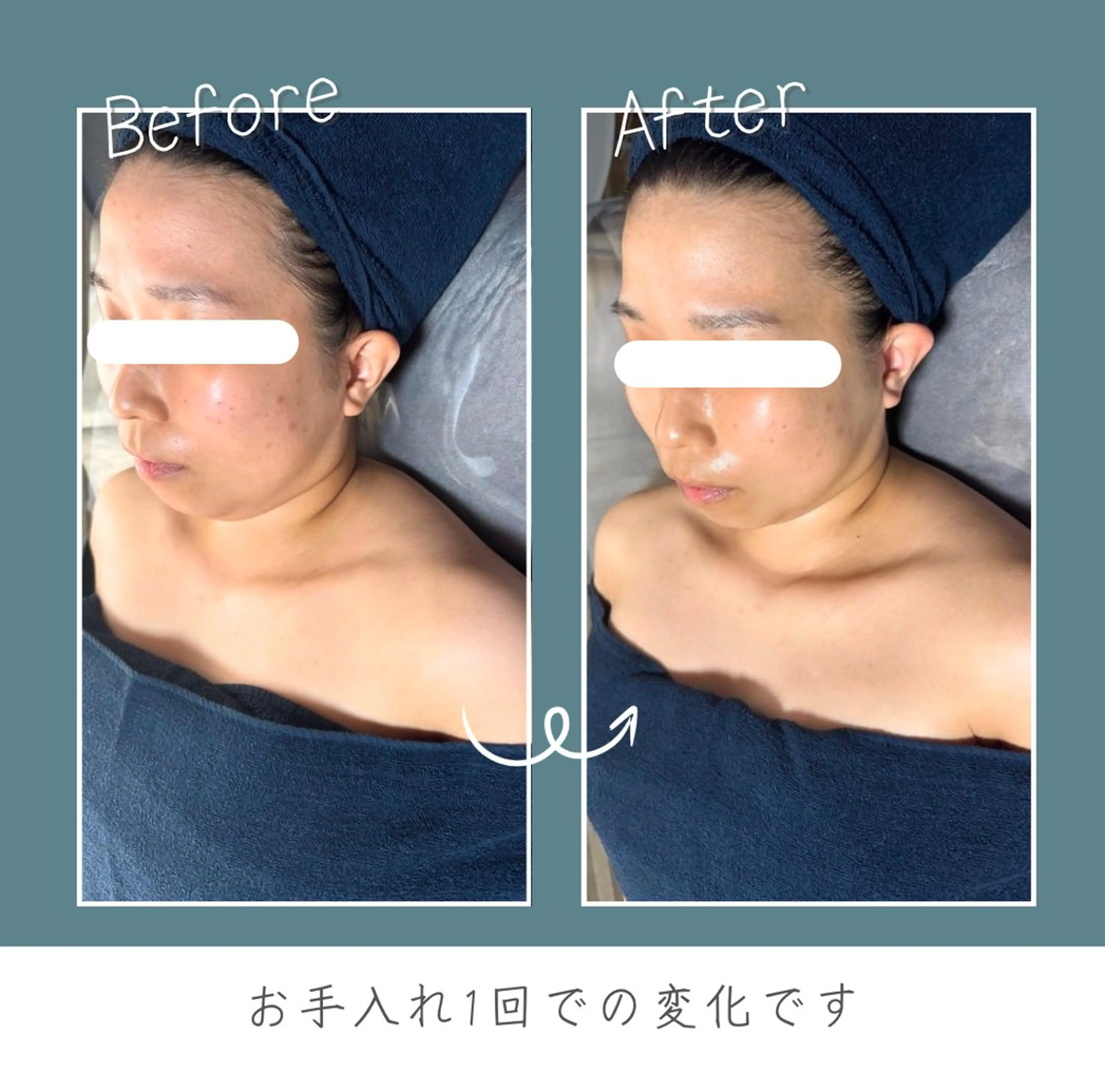 首肩のお疲れや盛り上がったボディラインをスッキリさせたい方はこちら(頭皮ケアサービス付き)の写真