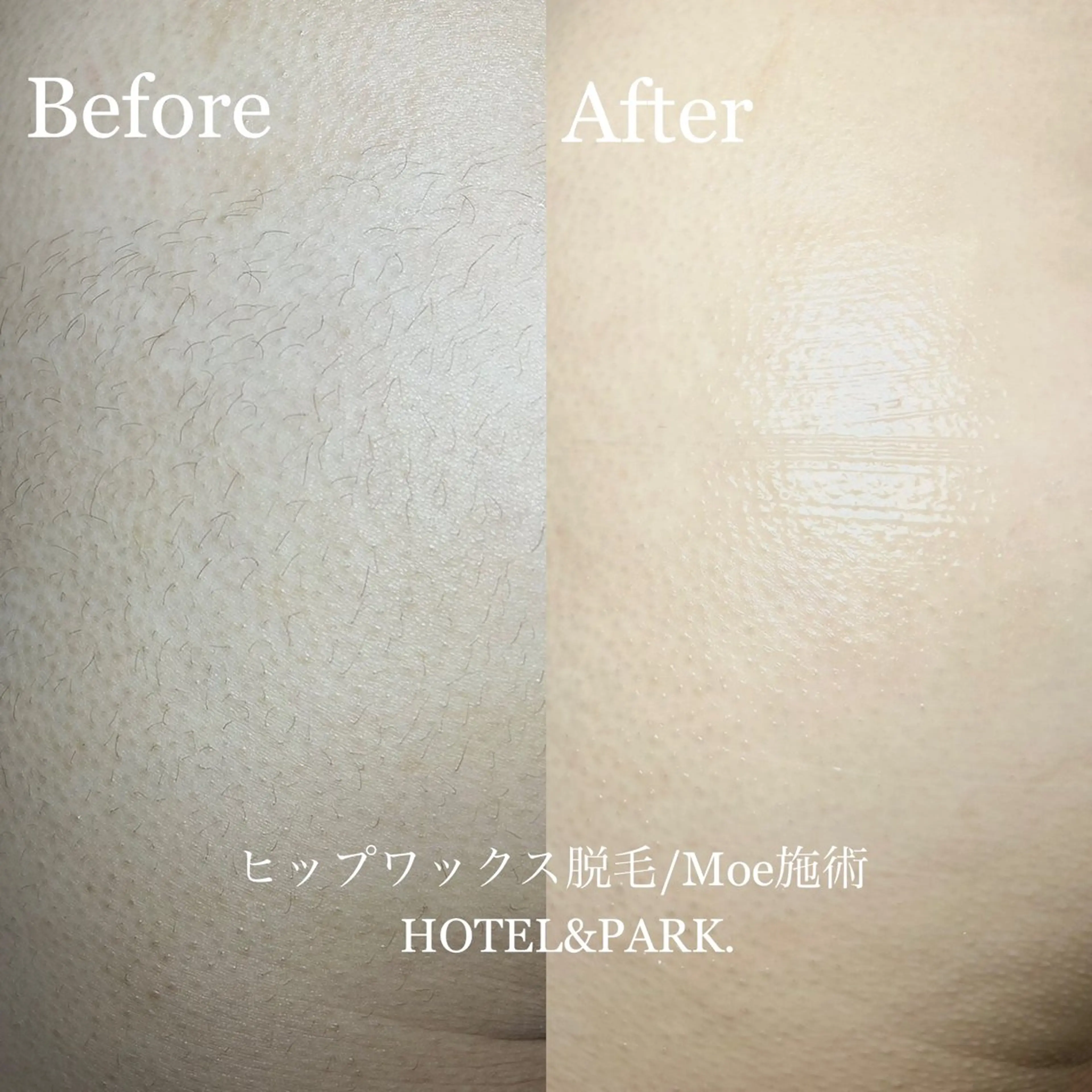 脱毛 HOTEL&PARK .Moeワックス脱毛のエステ・リラクイメージ