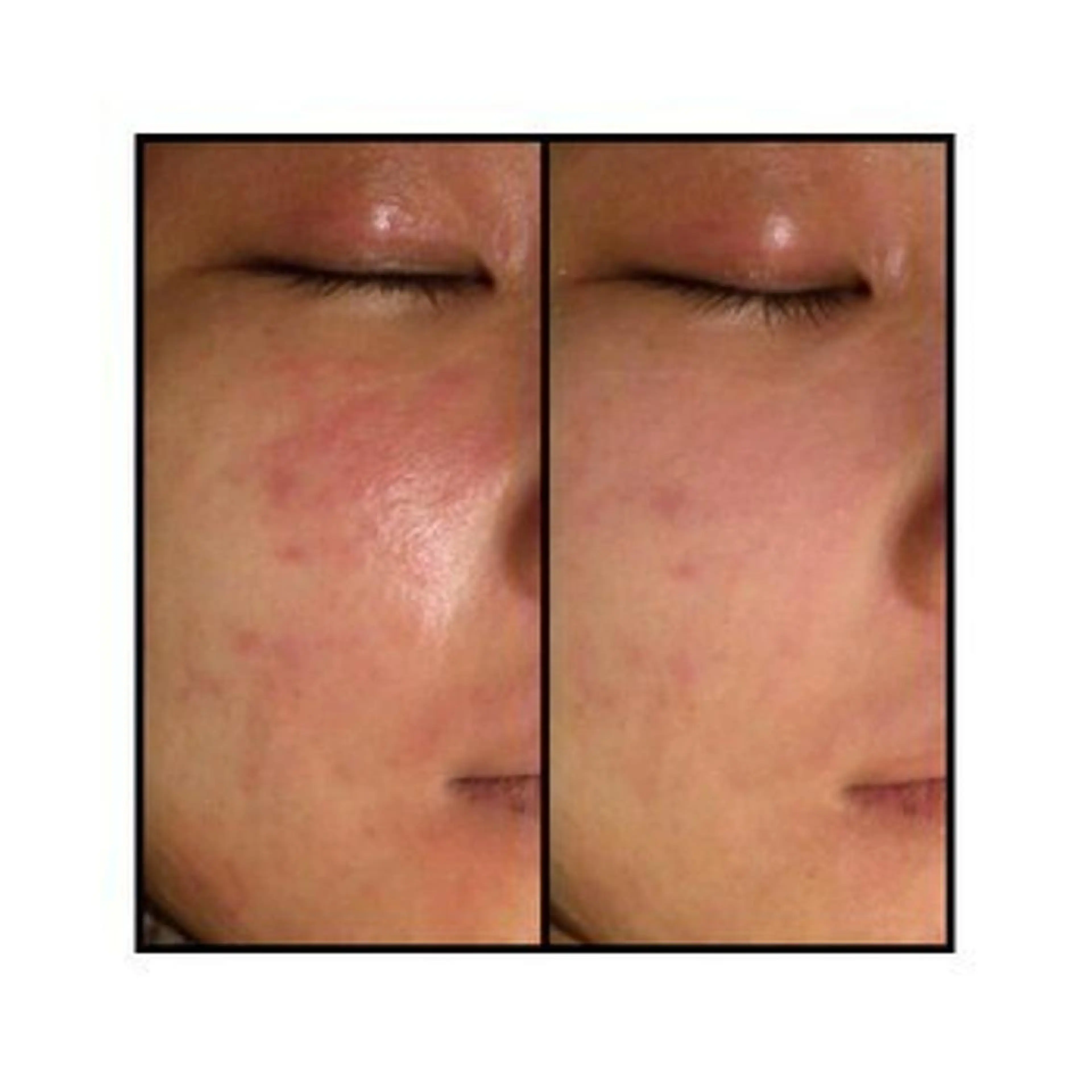 エステ リラク 🔥3か月で肌革命 🔥ニキビ専門店のエステ・リラクイメージ