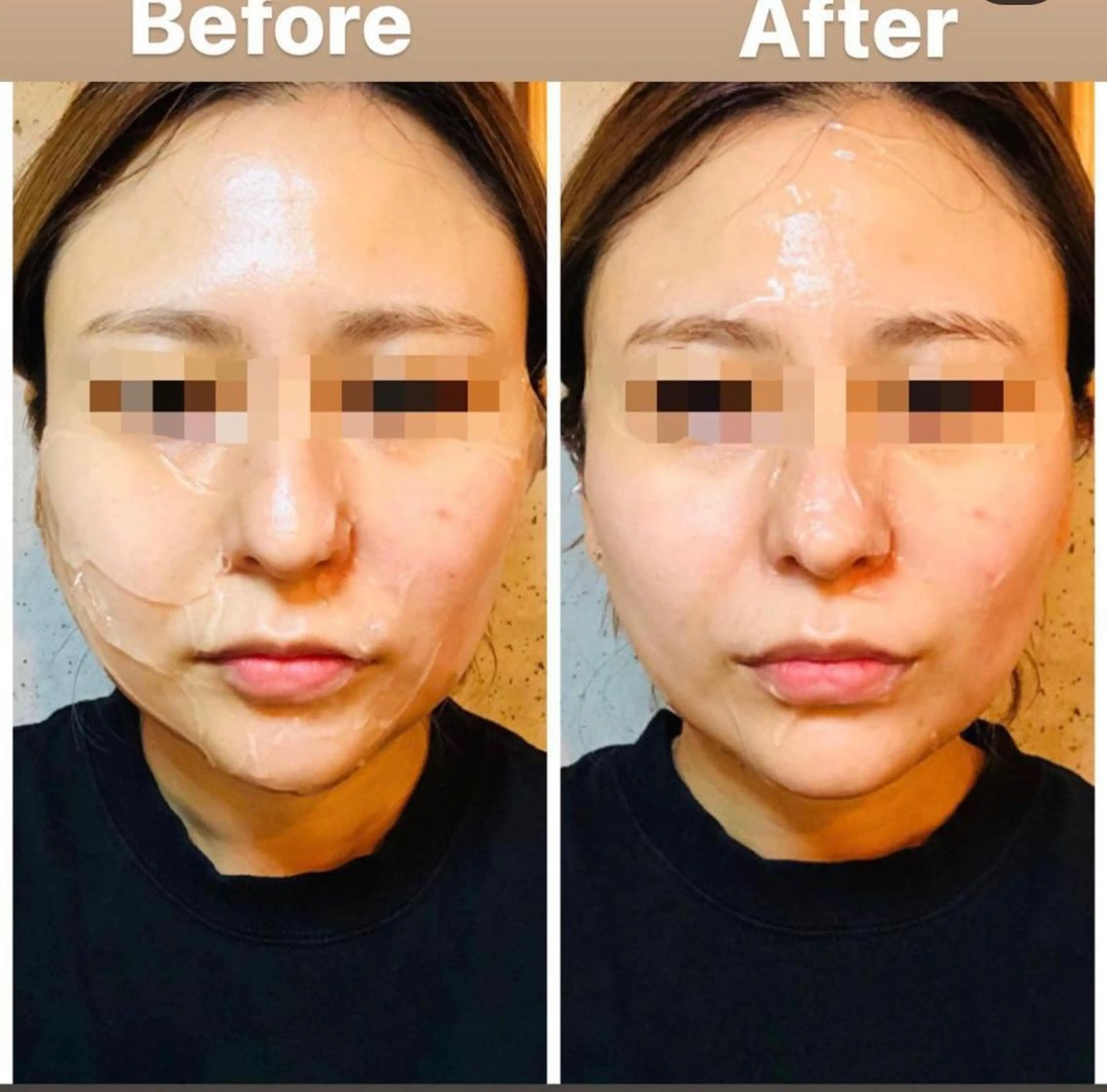 小顔リフトアップマシン【HI-FU】最新の機械でフェイスラインを引き締めます⭐️脂肪への照射・ダウンタイムなし🙆‍♀️の写真