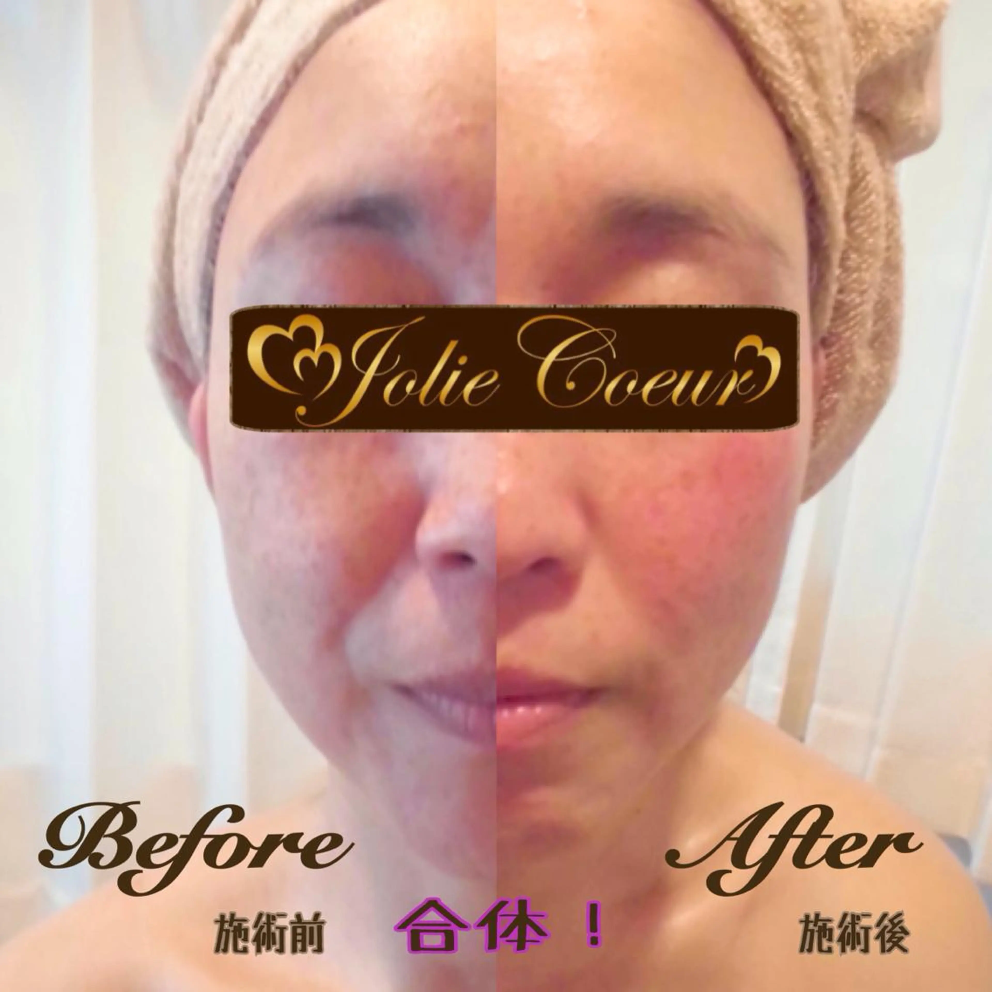 🌼モニター募集🌼インディバ®️フェイシャルの写真