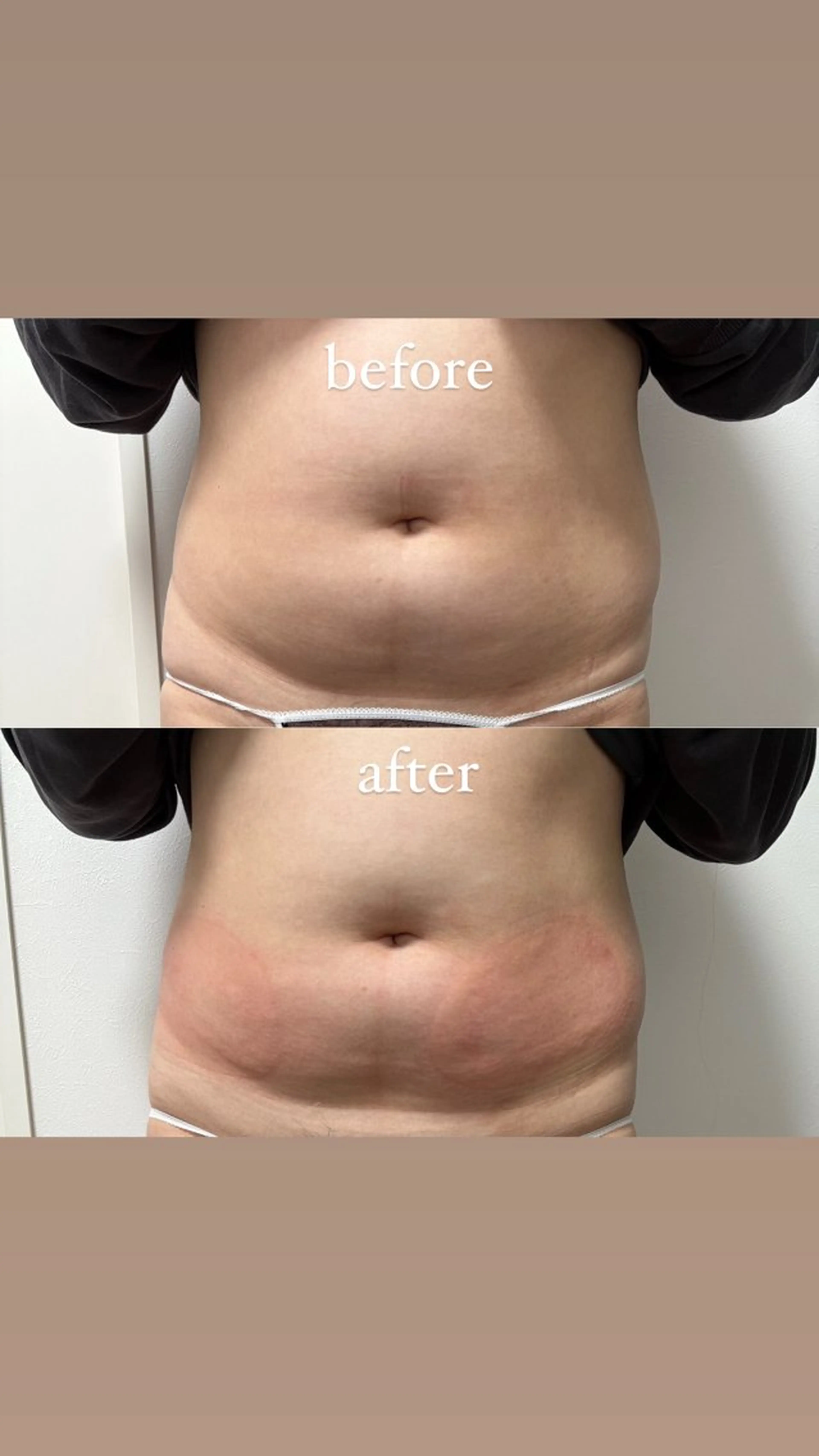 Miiju.所属・Miiju. 石巻市 脂肪冷却  鈴木のエステ・リラクイメージ