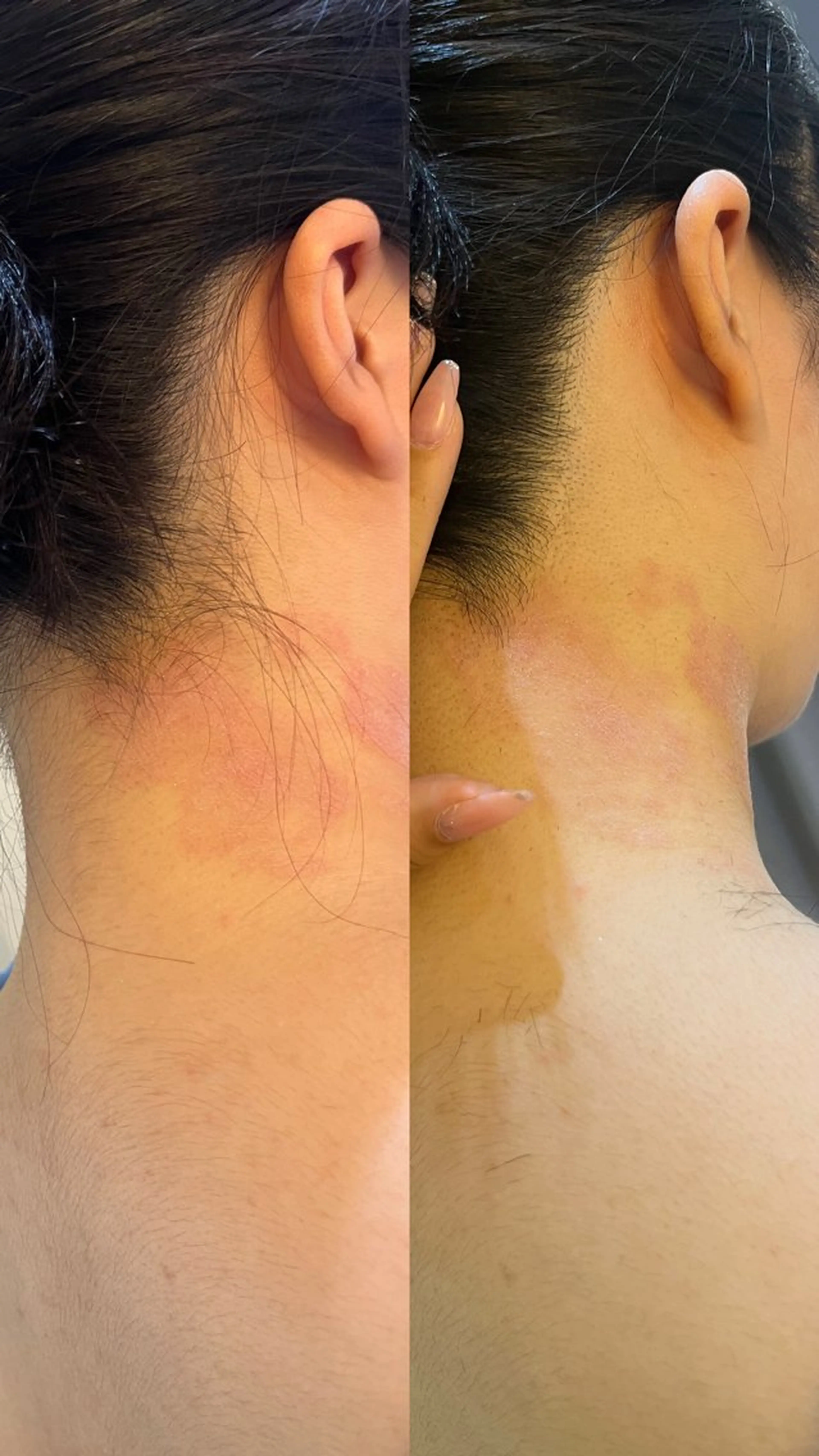 脱毛 うなじ脱毛/美肌脱毛 LABELのエステ・リラクイメージ