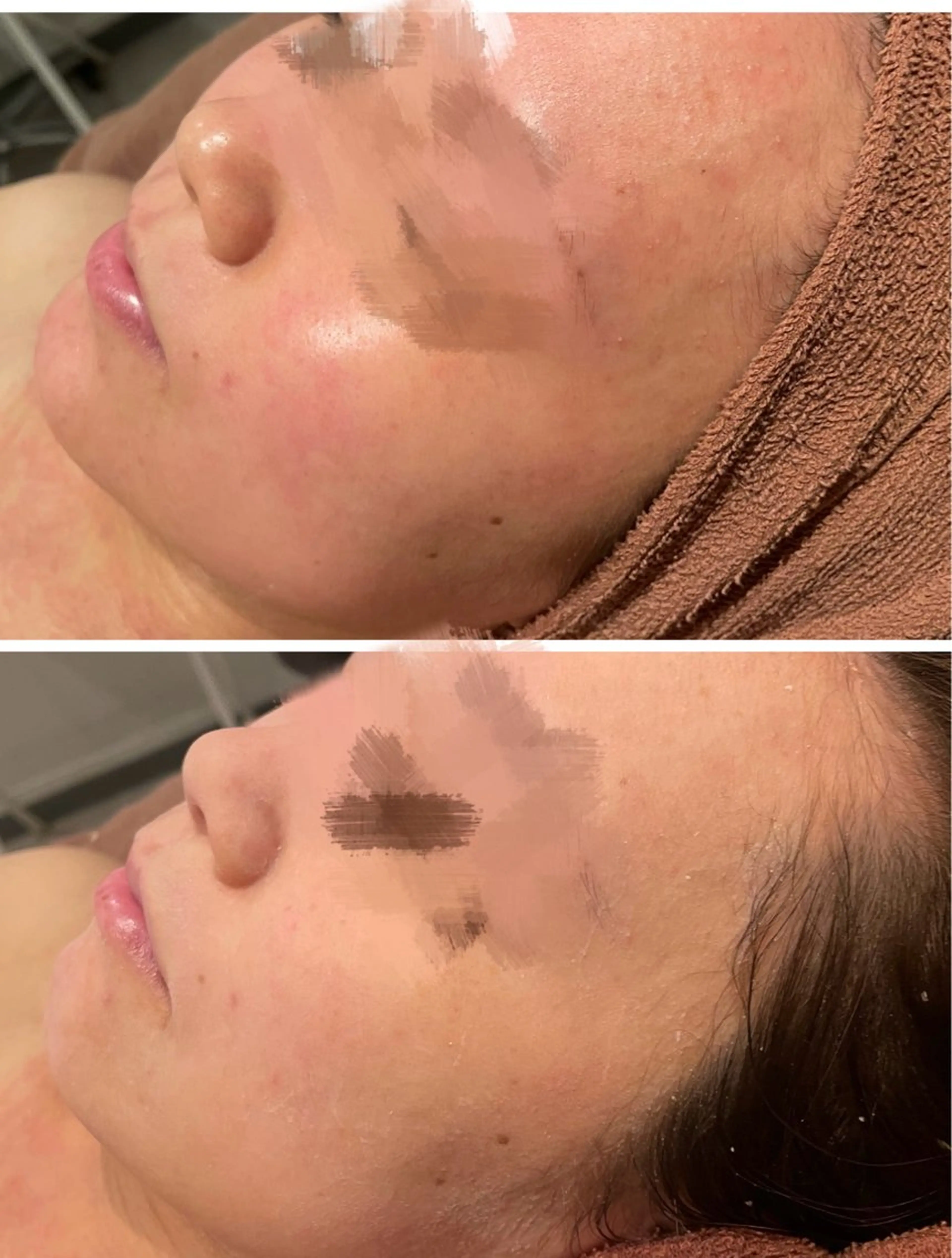 エステ リラク ニキビ特化型エステ 🍓最短で肌質改善のその他イメージ