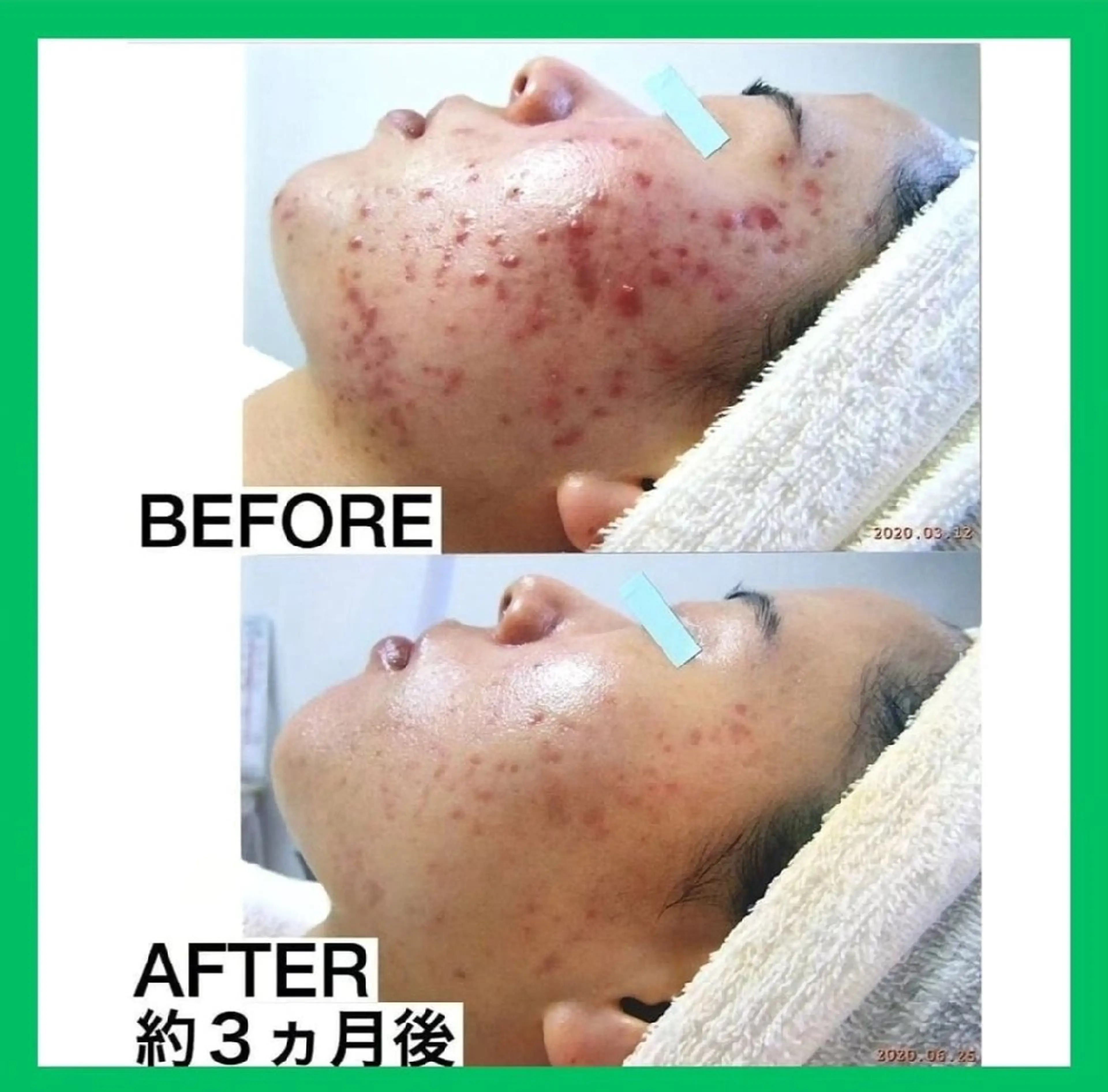 エステ ニキビケア◇ニキビ跡 レゾン京橋店　峠山のエステ・リラクイメージ