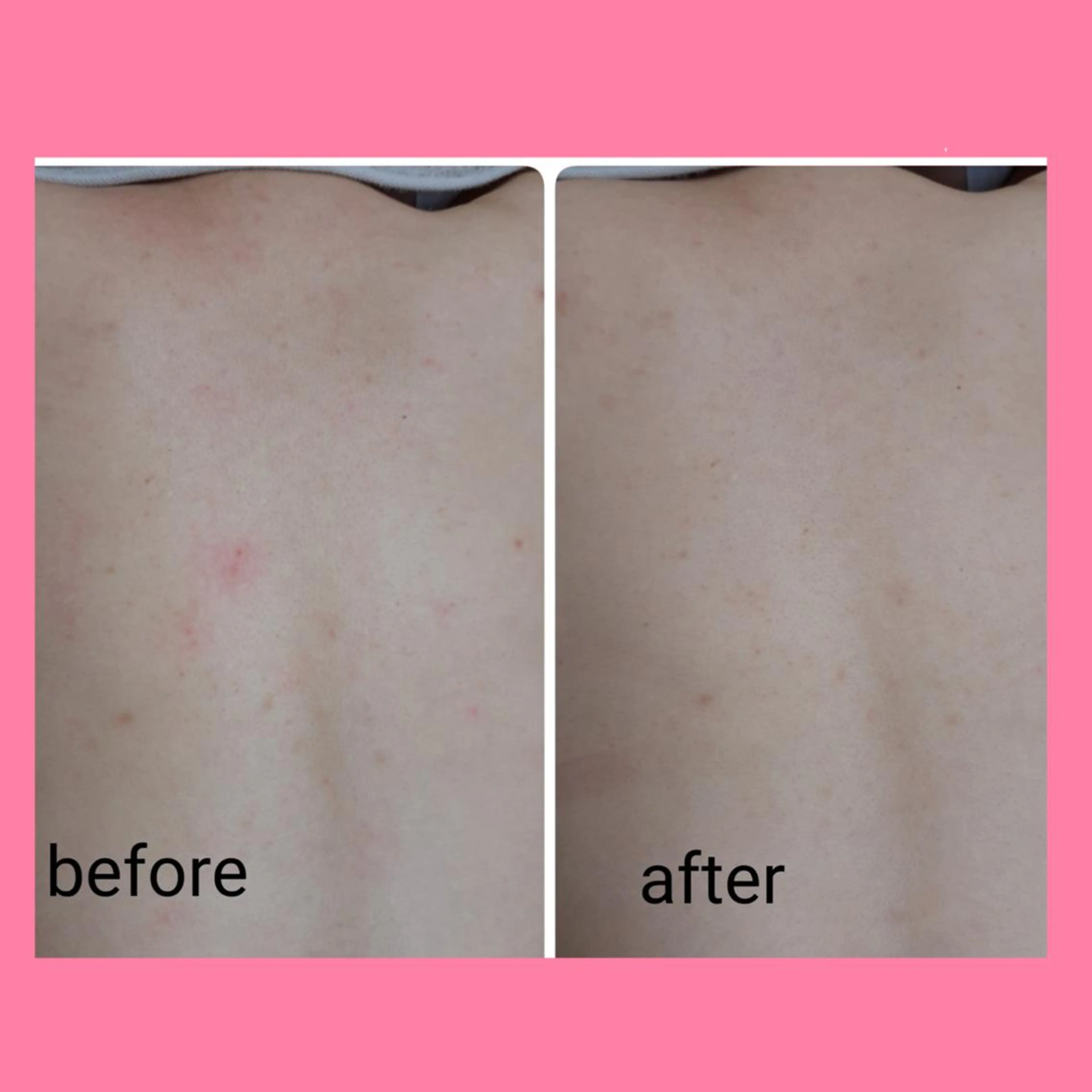 徹底背中ケア【ニキビケア×ニキビ跡など】本気でお悩みの方(4step)背面ハーブピーリング+保湿パック¥8900の写真