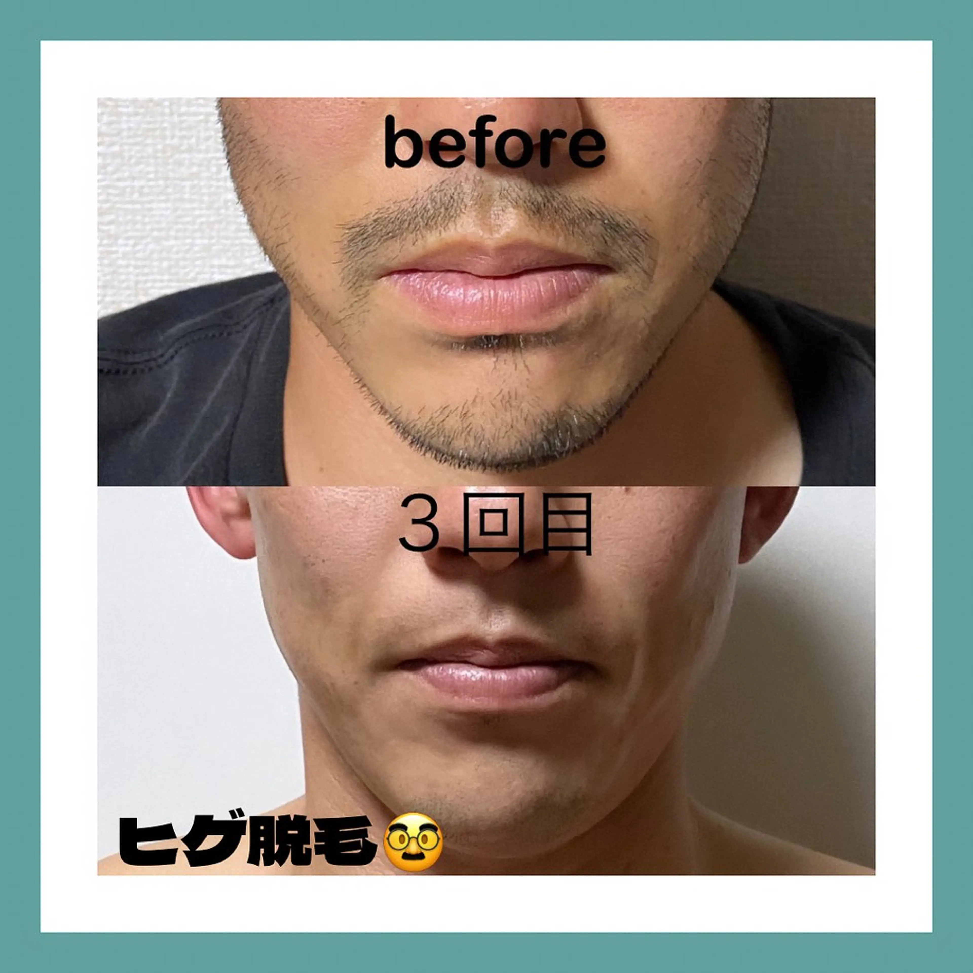 メンズ　髭脱毛🥸の写真