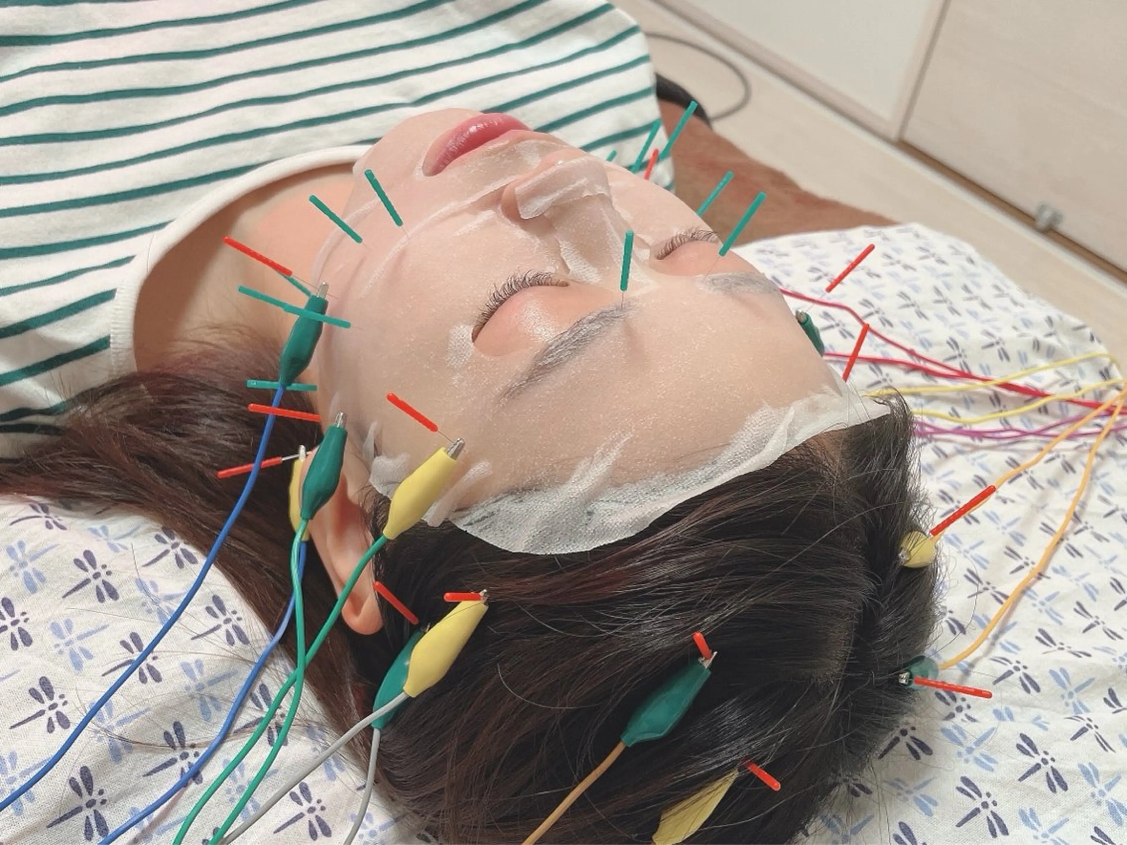 【ミニモ限定🦔口コミ投稿ご協力→初診料無料】ヒト幹細胞電気美容鍼🪡の写真