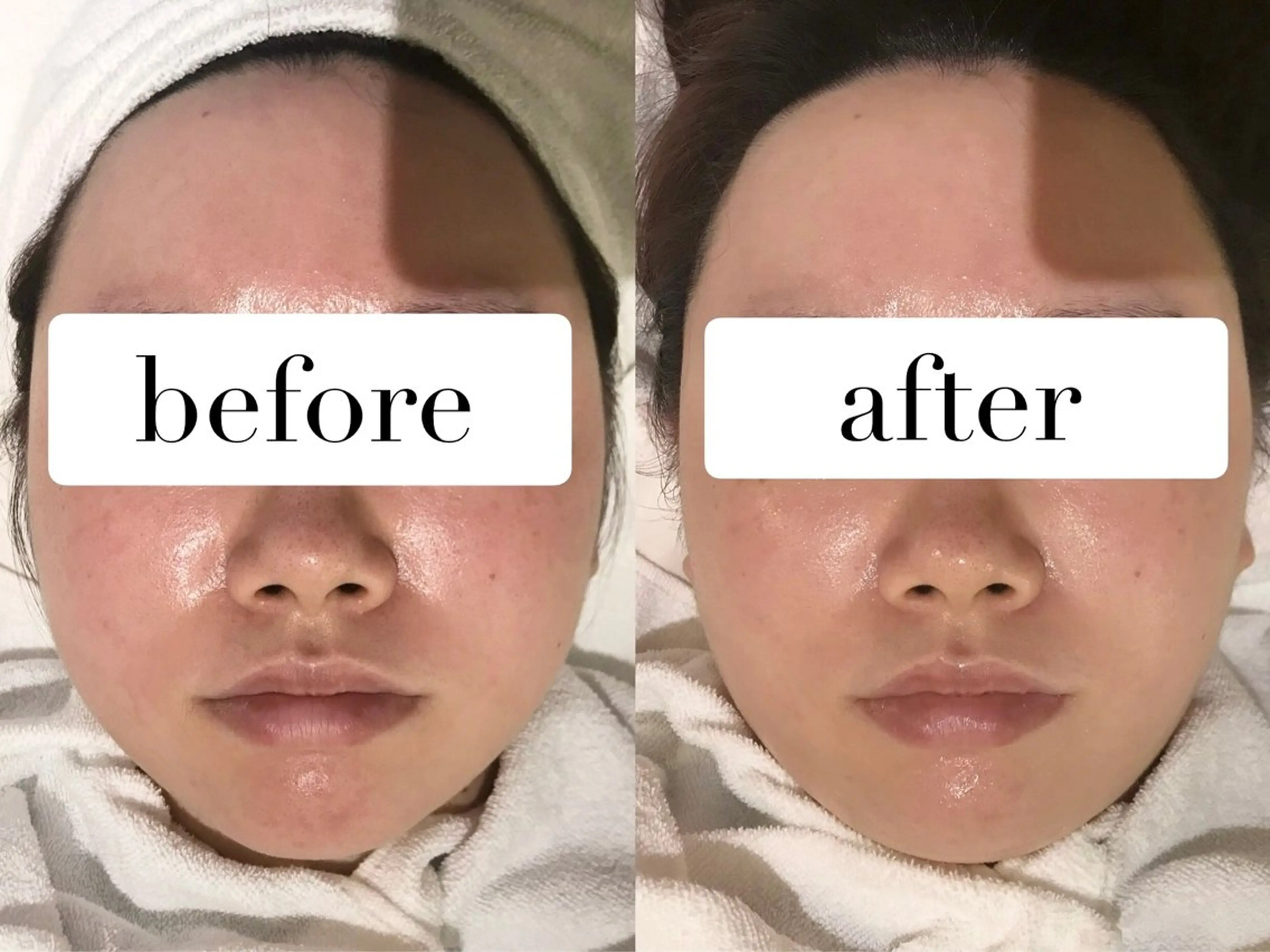 【劇的美肌再生】透明感×ハリ艶◎ルネセルピーリングで内側から輝く素肌へ🌟の写真