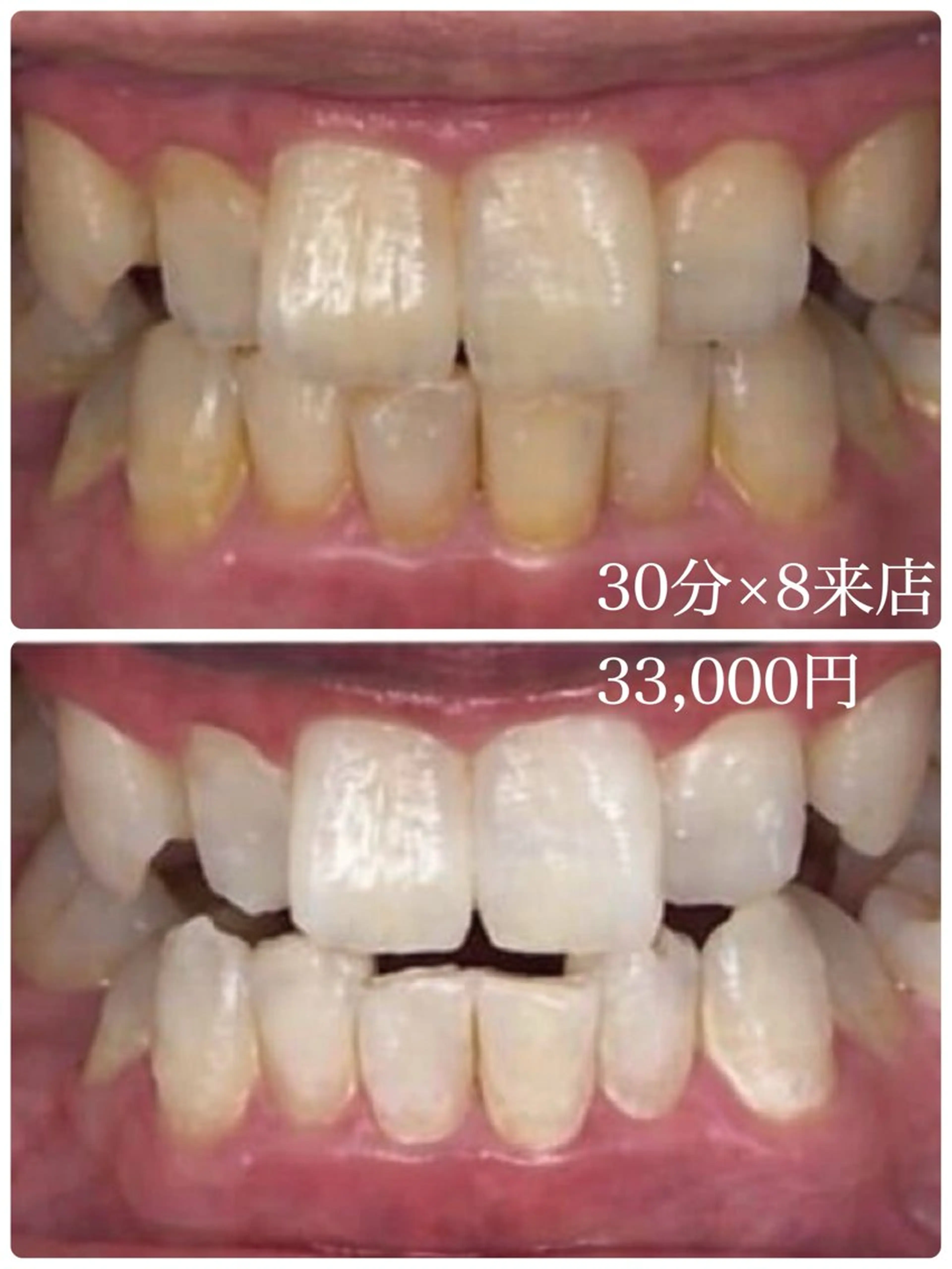 エステ プラチナムビューティー柏所属・【歯科提携】柏ホワイ トニングスタイルのその他イメージ