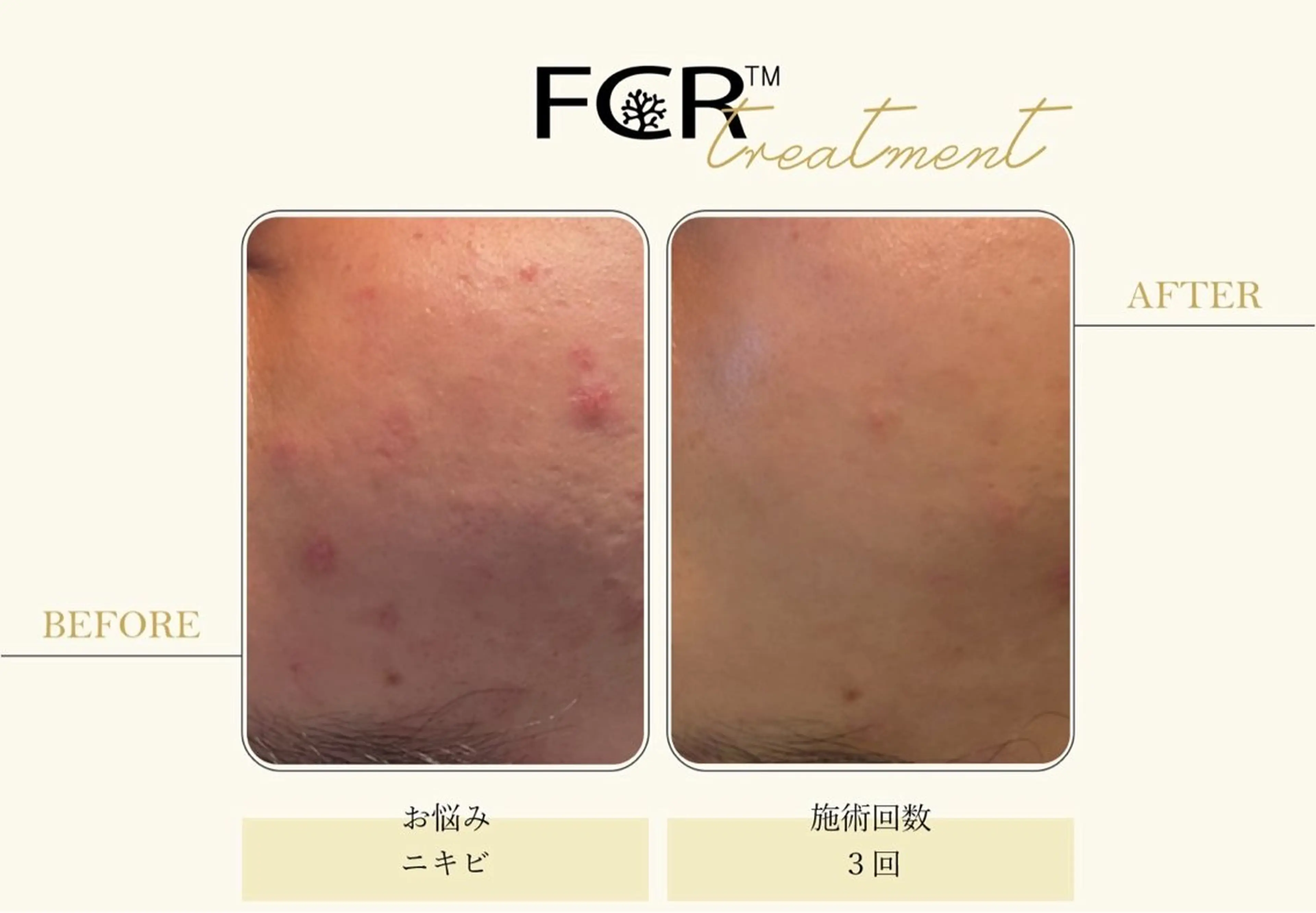 ニキビ改善シャルム ココハーブピーリングのエステ・リラクイメージ