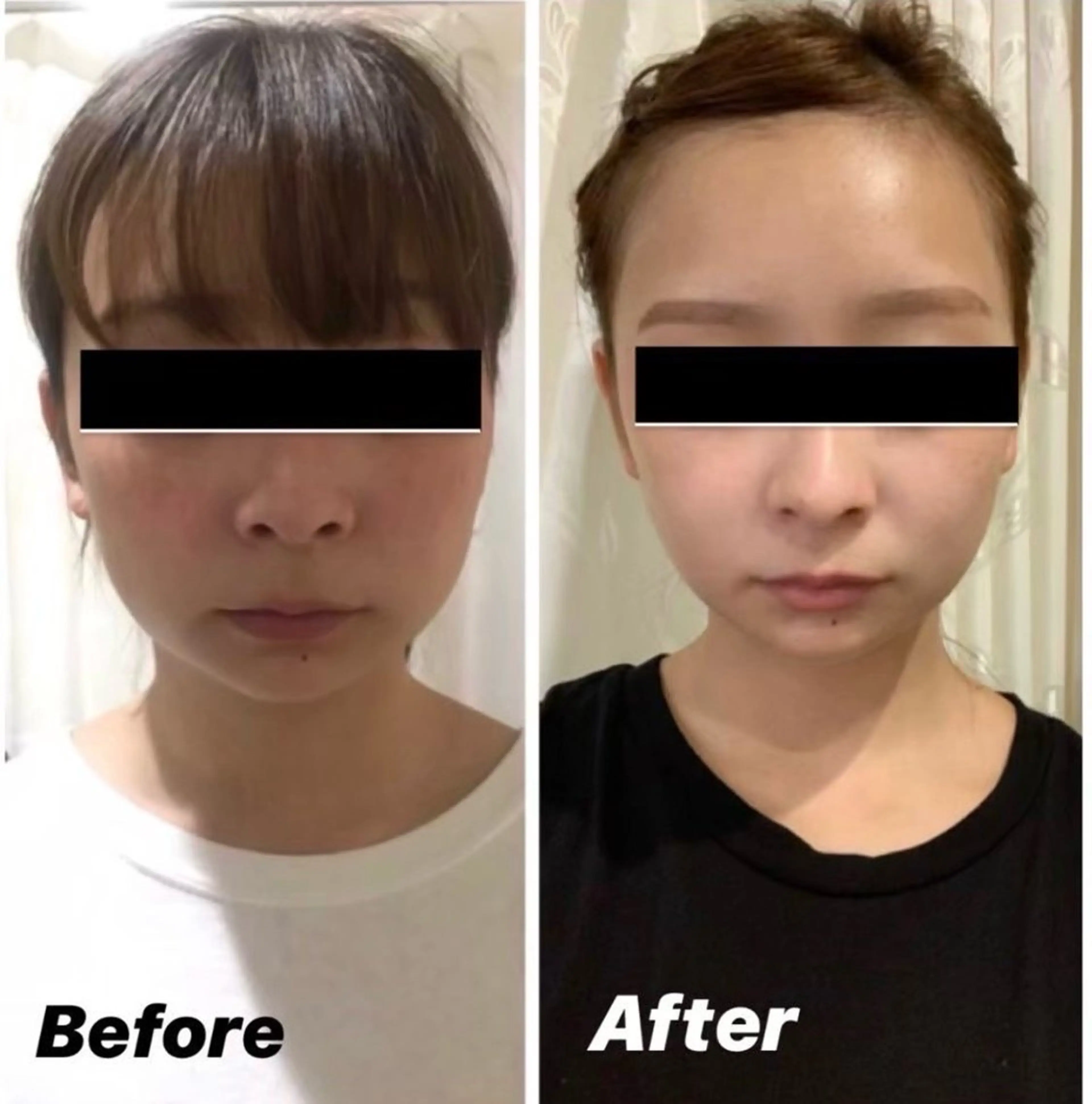 高周波インモードリフトの写真