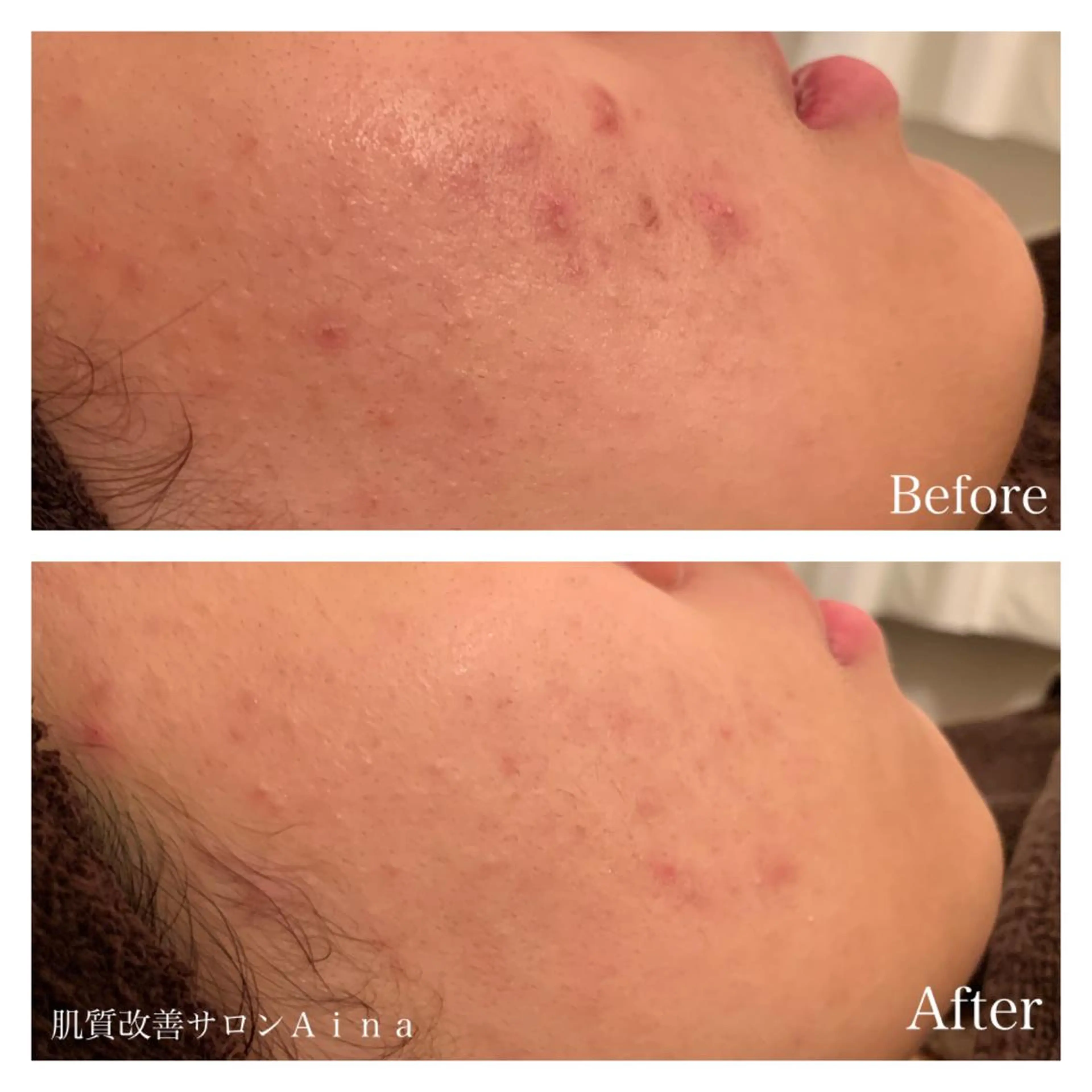 ミディアム パーマ キッズ ネイル マツエク・マツパ 学生 エステ リラク ニキビ跡専門サロン Ainaのエステ・リラクイメージ