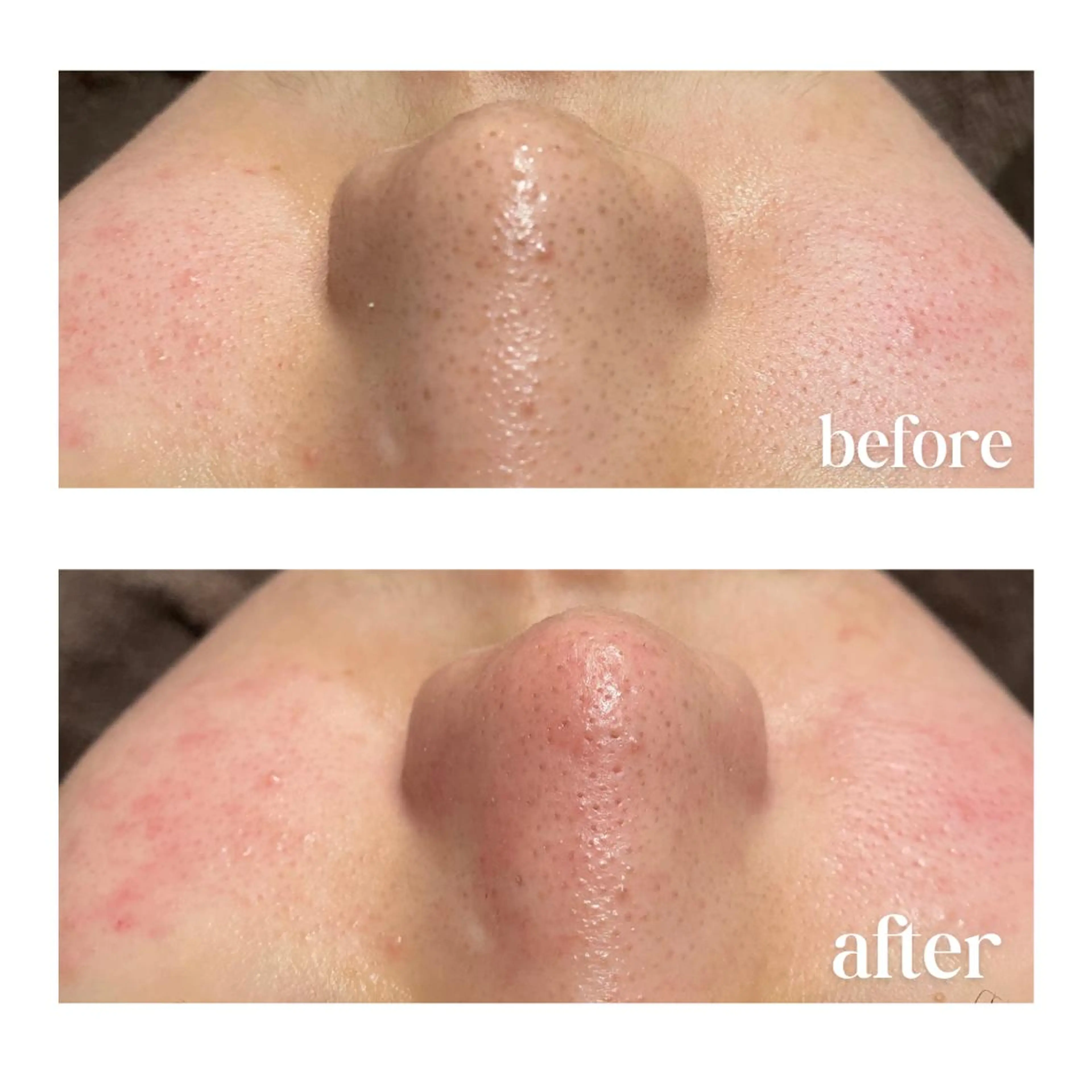 《黒ずみ/角栓/ニキビ/皮脂》高濃度VC◆水光艶肌ハイドロfacial🫧の写真