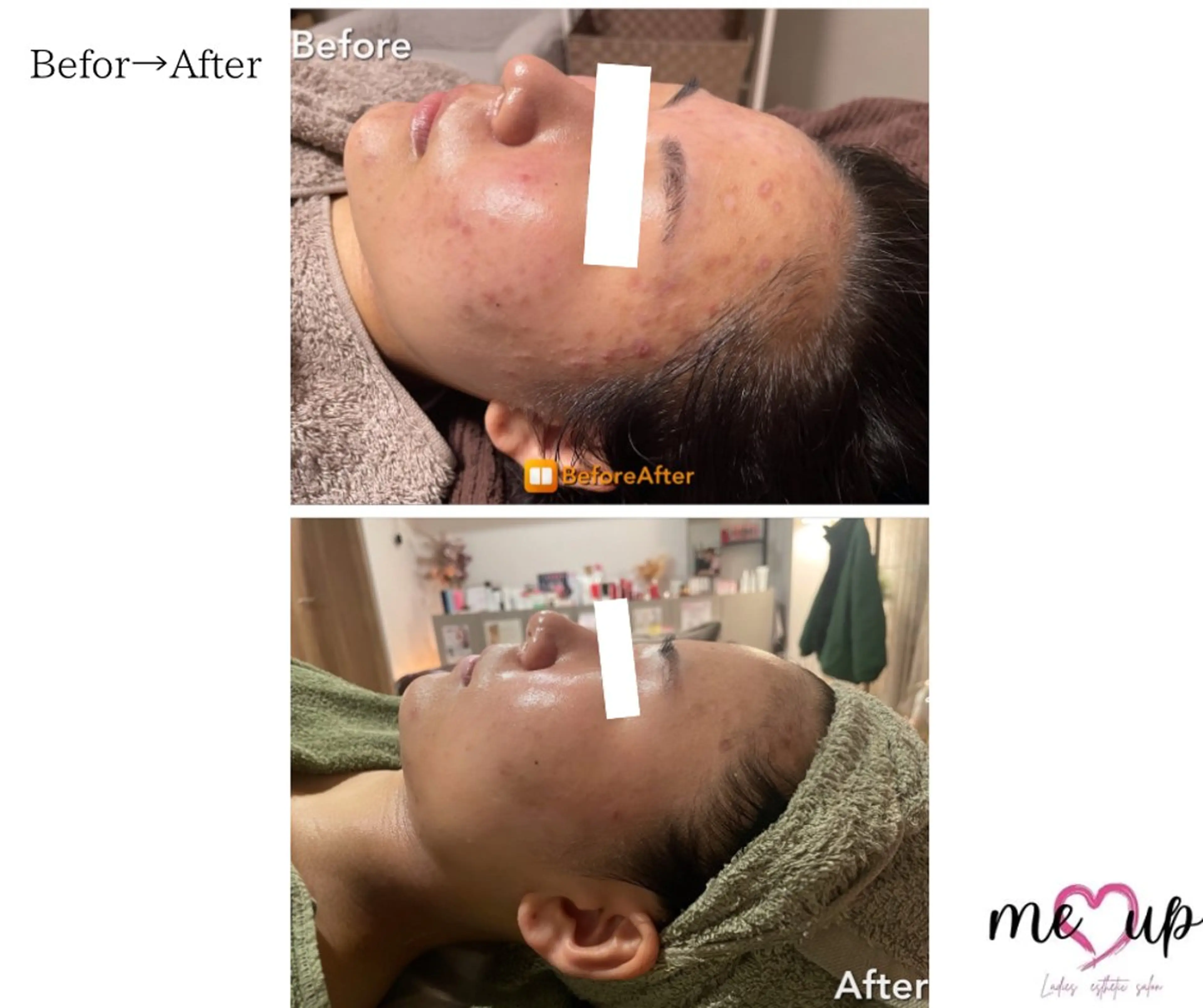 エステ Meupニキビ専門店 背中/ハーブ/肌管理のその他イメージ