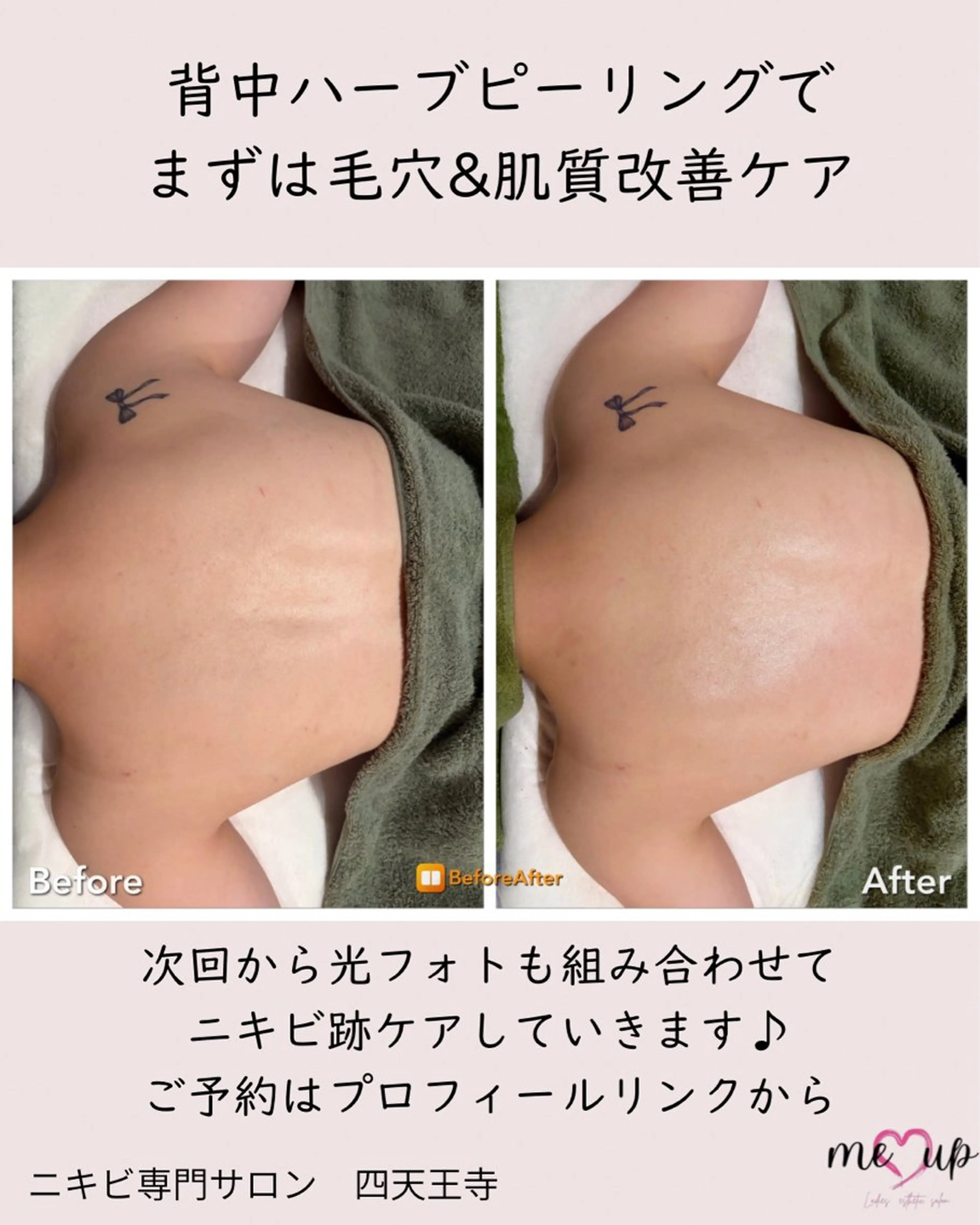 エステ Meupニキビ専門店 背中/ハーブ/肌管理のその他イメージ