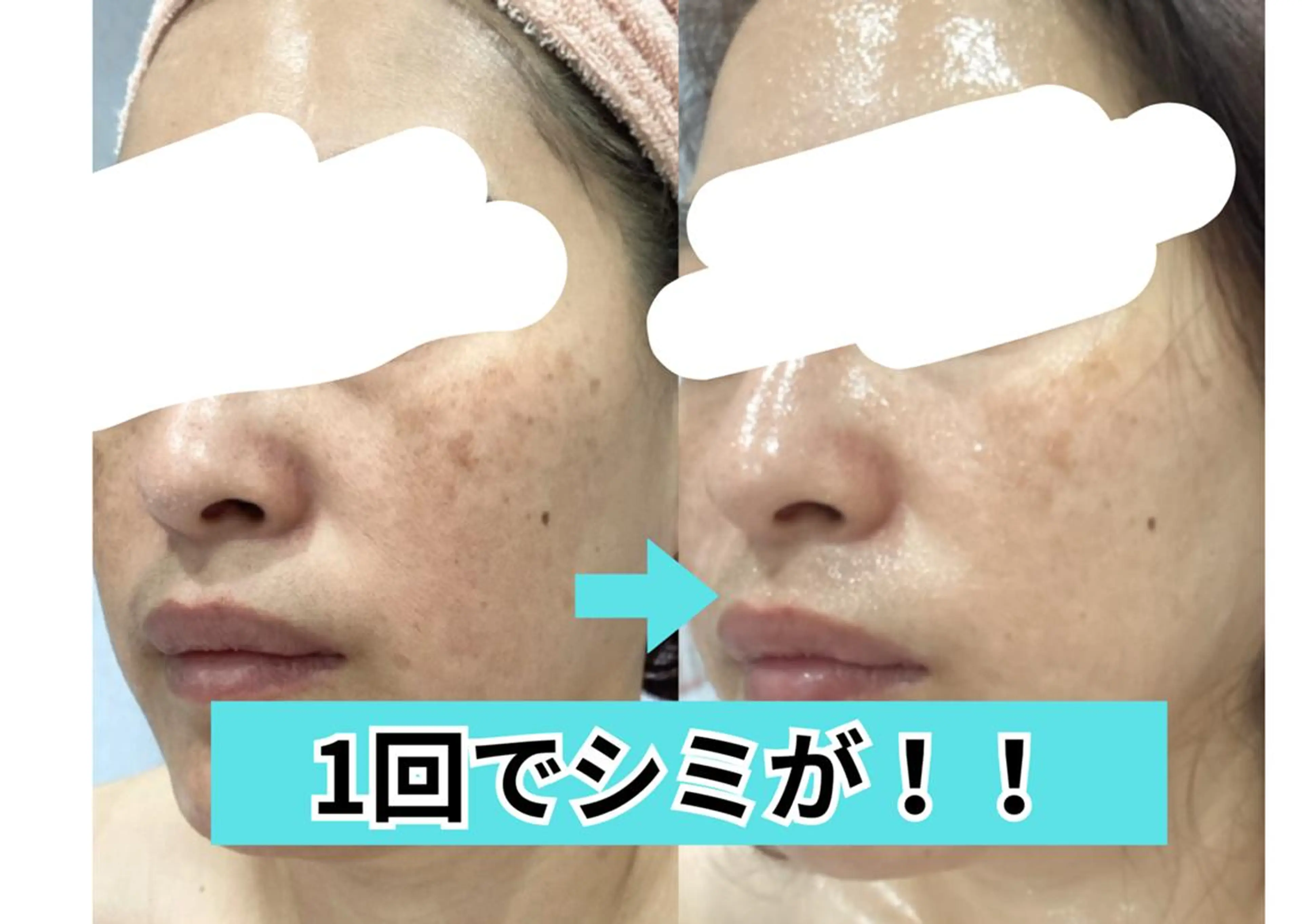 【透き通るような透明感を】🤍徹底美白シミケア体験🤍[兵庫県尼崎市/痩身エステ]の写真