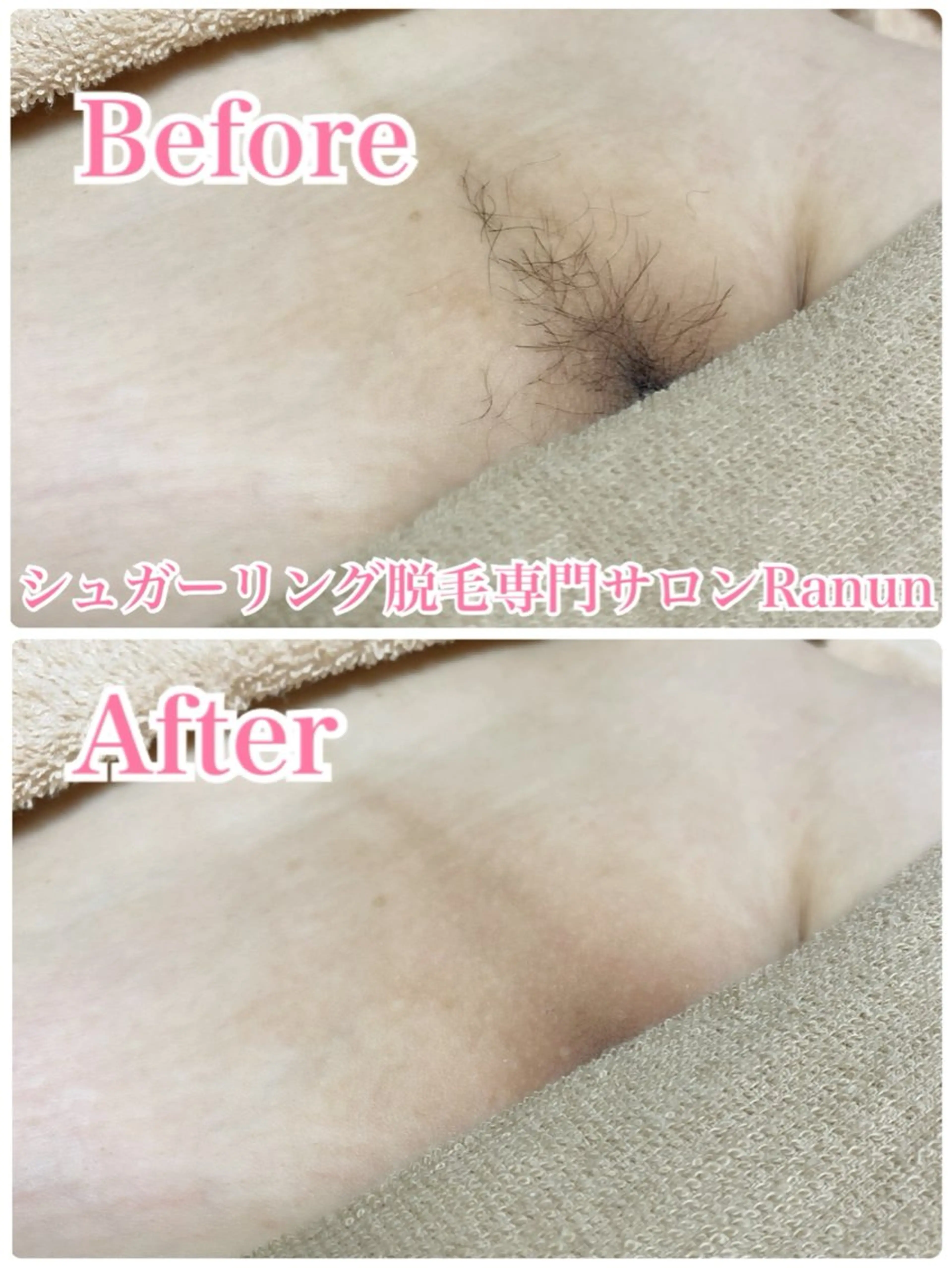 カラー 脱毛 シュガーリング脱毛 専門店Ranunのエステ・リラクイメージ